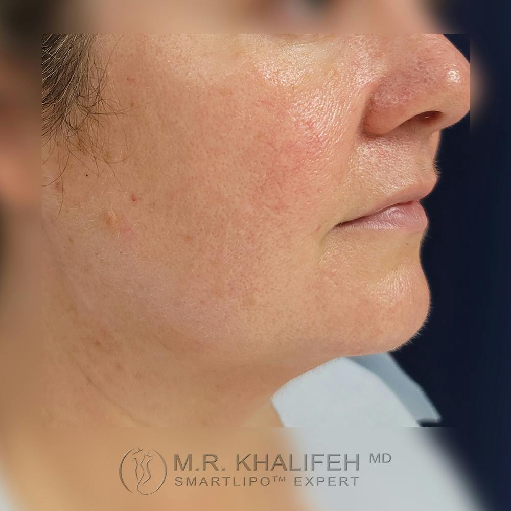 Chin and Neck Liposuction Gallery - Patient 121765630 - Image 5