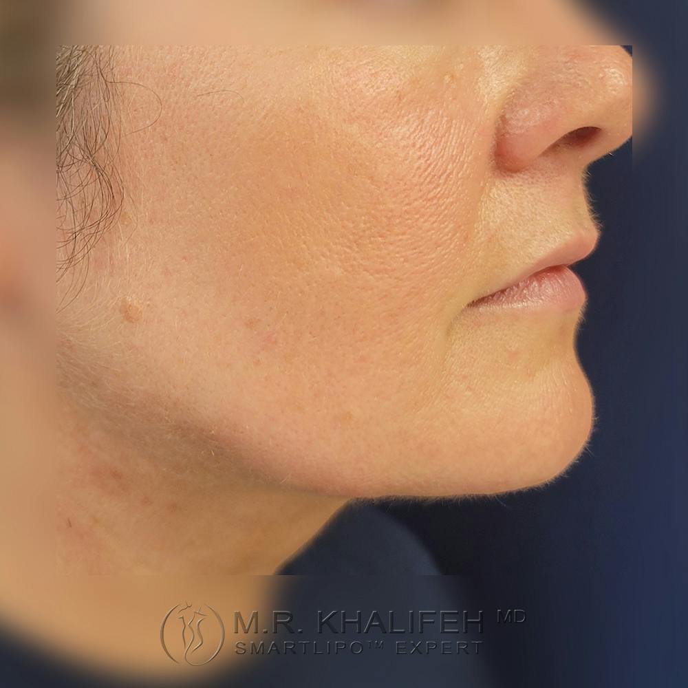 Chin and Neck Liposuction Gallery - Patient 121765630 - Image 6
