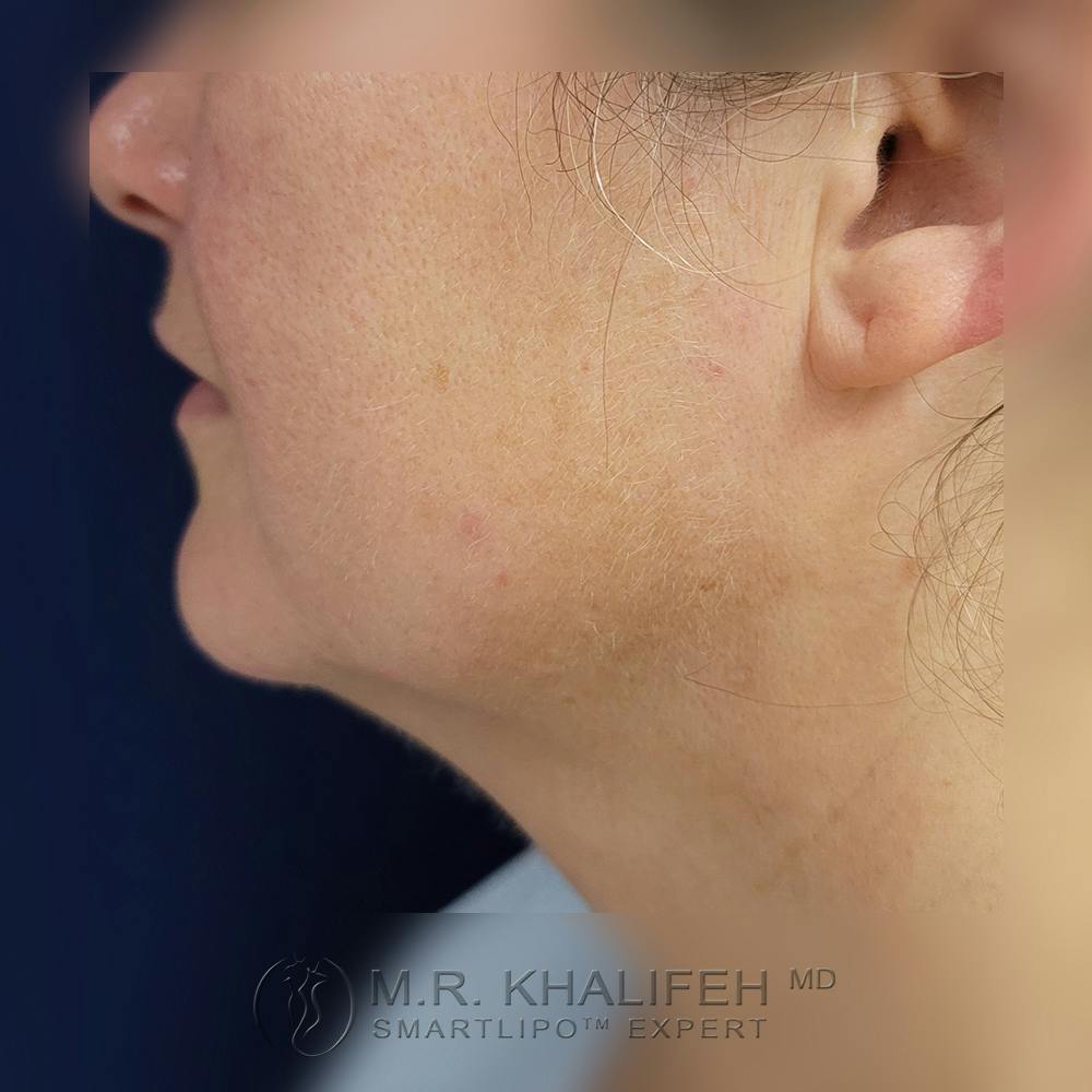 Buccal Fat Pad Excision Gallery - Patient 121765631 - Image 7