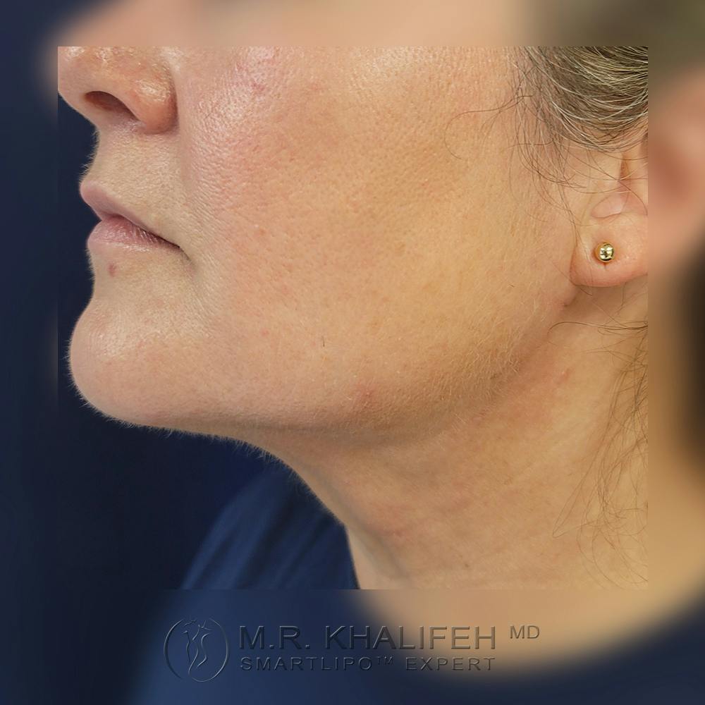 Chin and Neck Liposuction Gallery - Patient 121765630 - Image 10