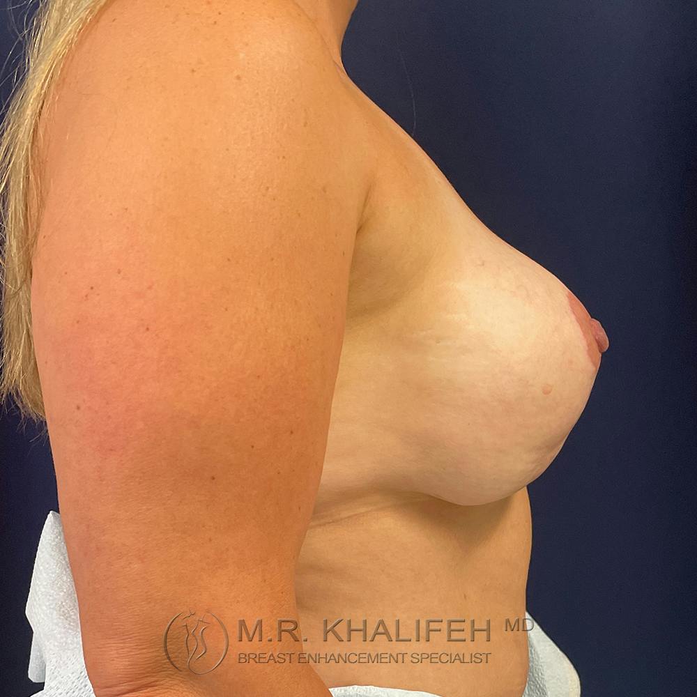 Breast Lift Gallery - Patient 121765645 - Image 3
