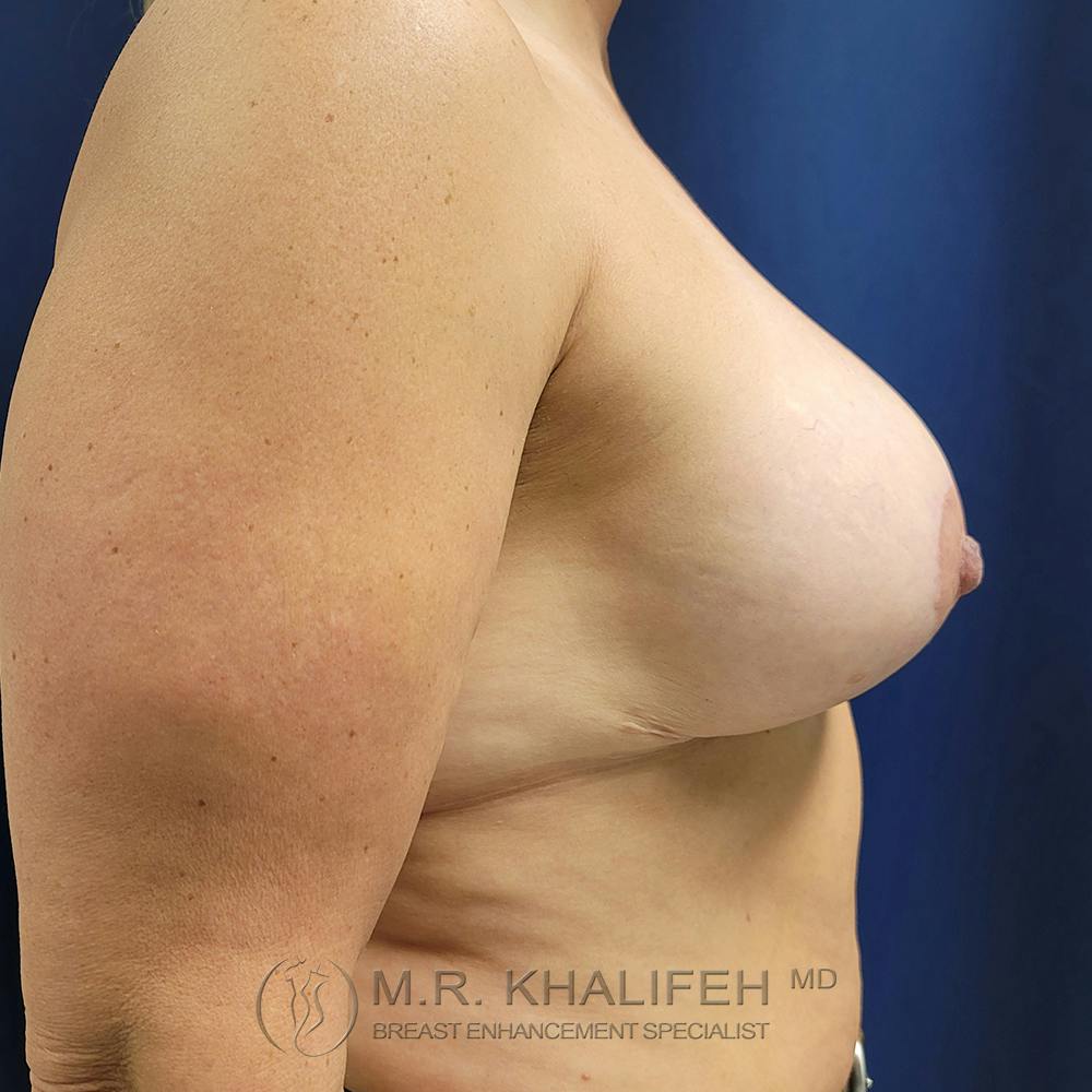 Breast Lift Gallery - Patient 121765645 - Image 4