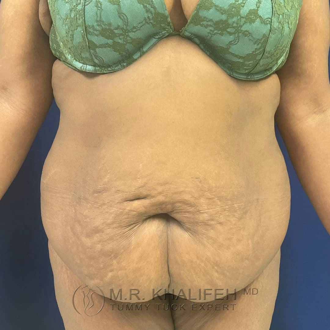 Tummy Tuck Gallery - Patient 122227098 - Image 1