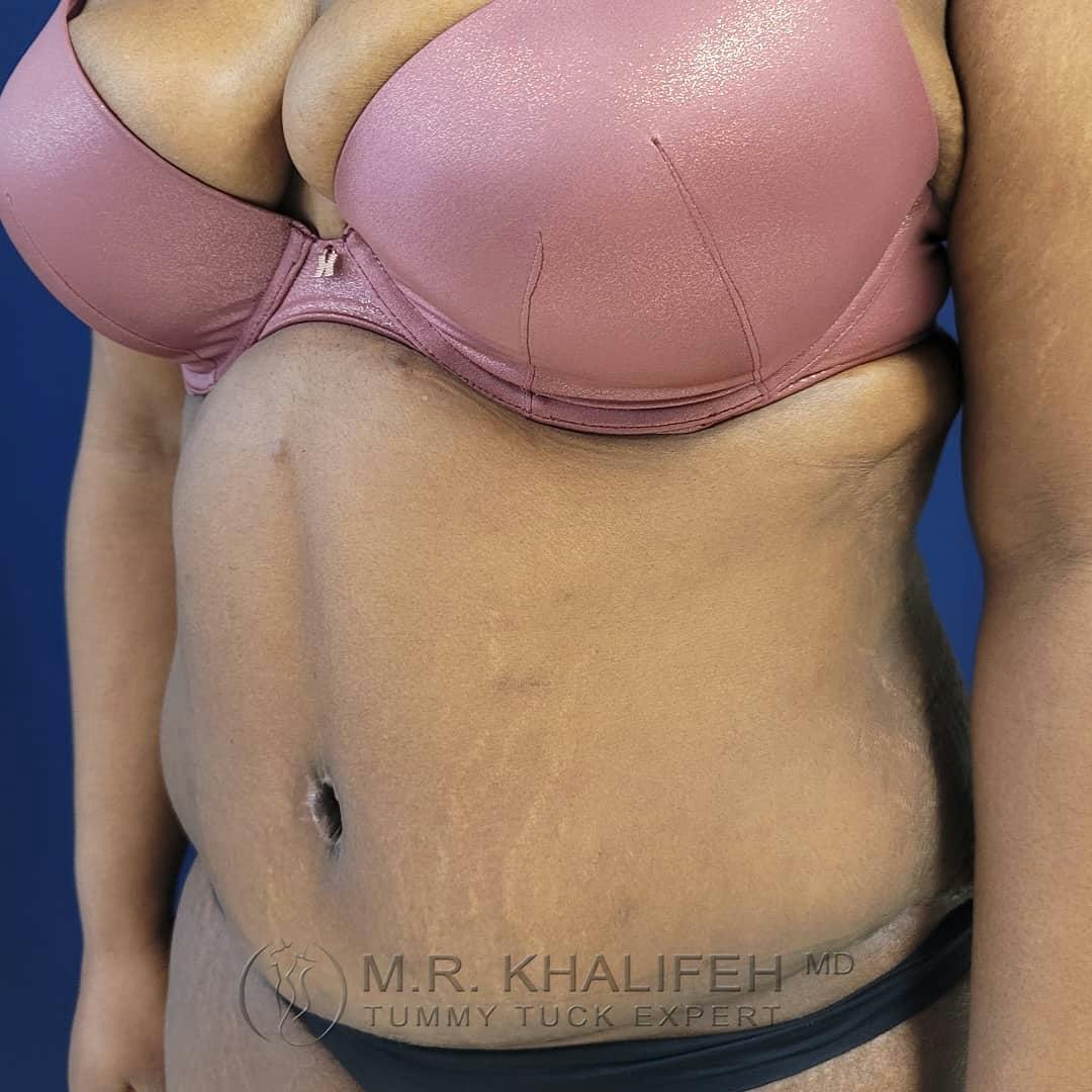Tummy Tuck Gallery - Patient 122227098 - Image 6