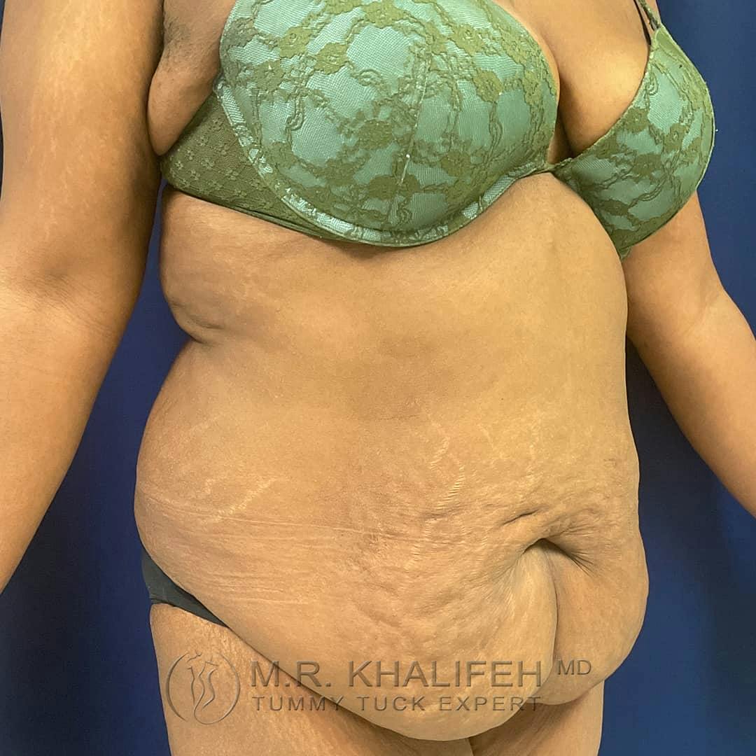 Tummy Tuck Gallery - Patient 122227098 - Image 3