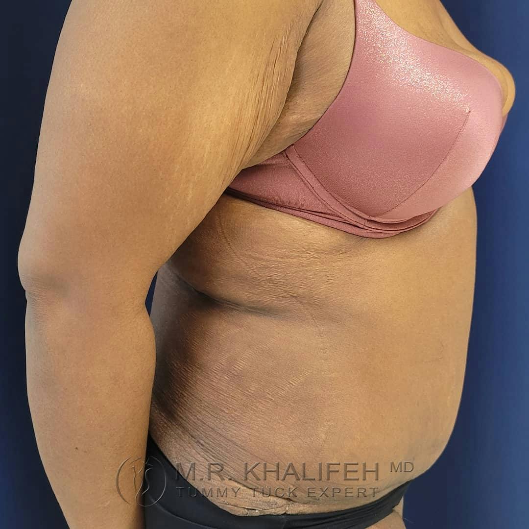 Tummy Tuck Gallery - Patient 122227098 - Image 8