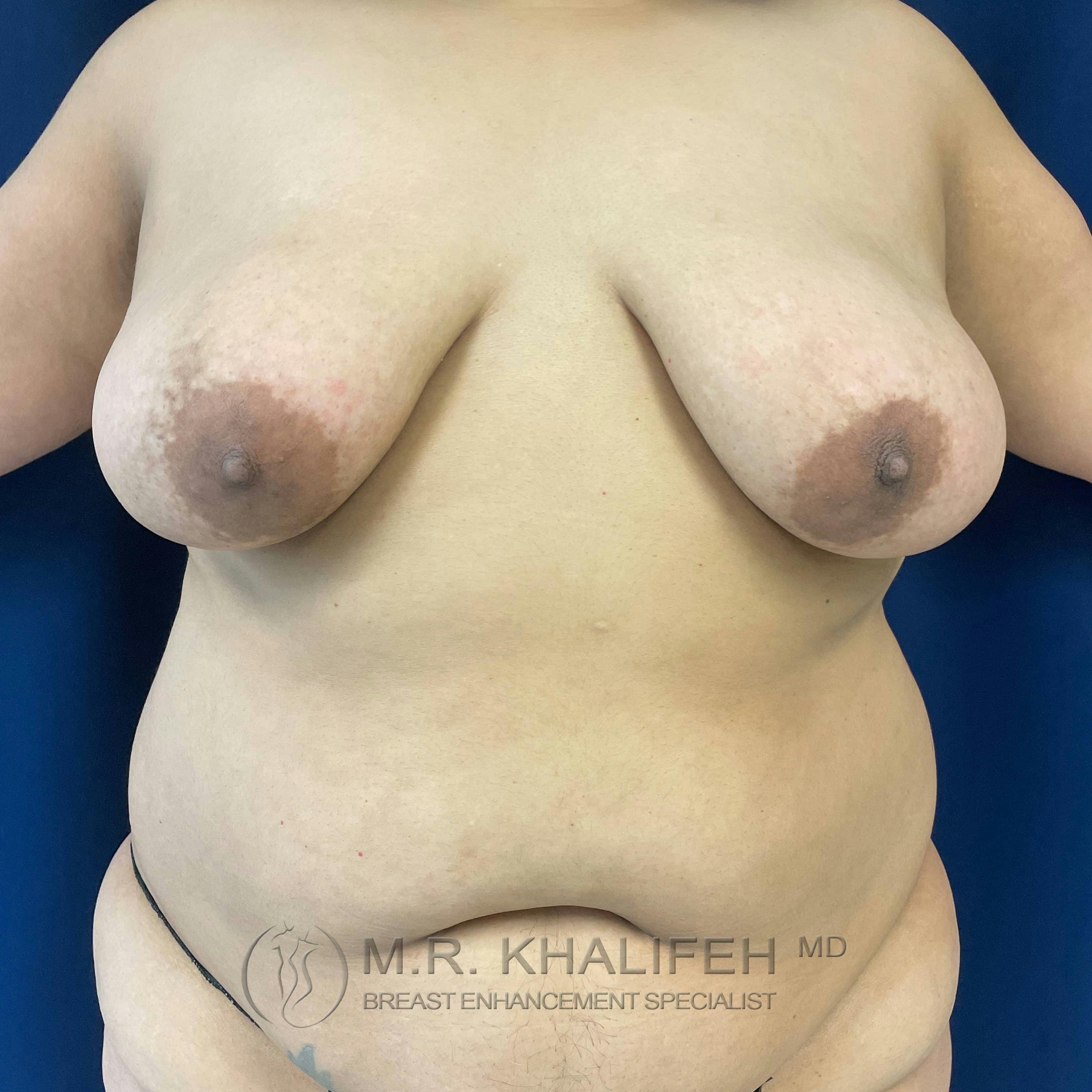 Breast Lift Gallery - Patient 122227116 - Image 1