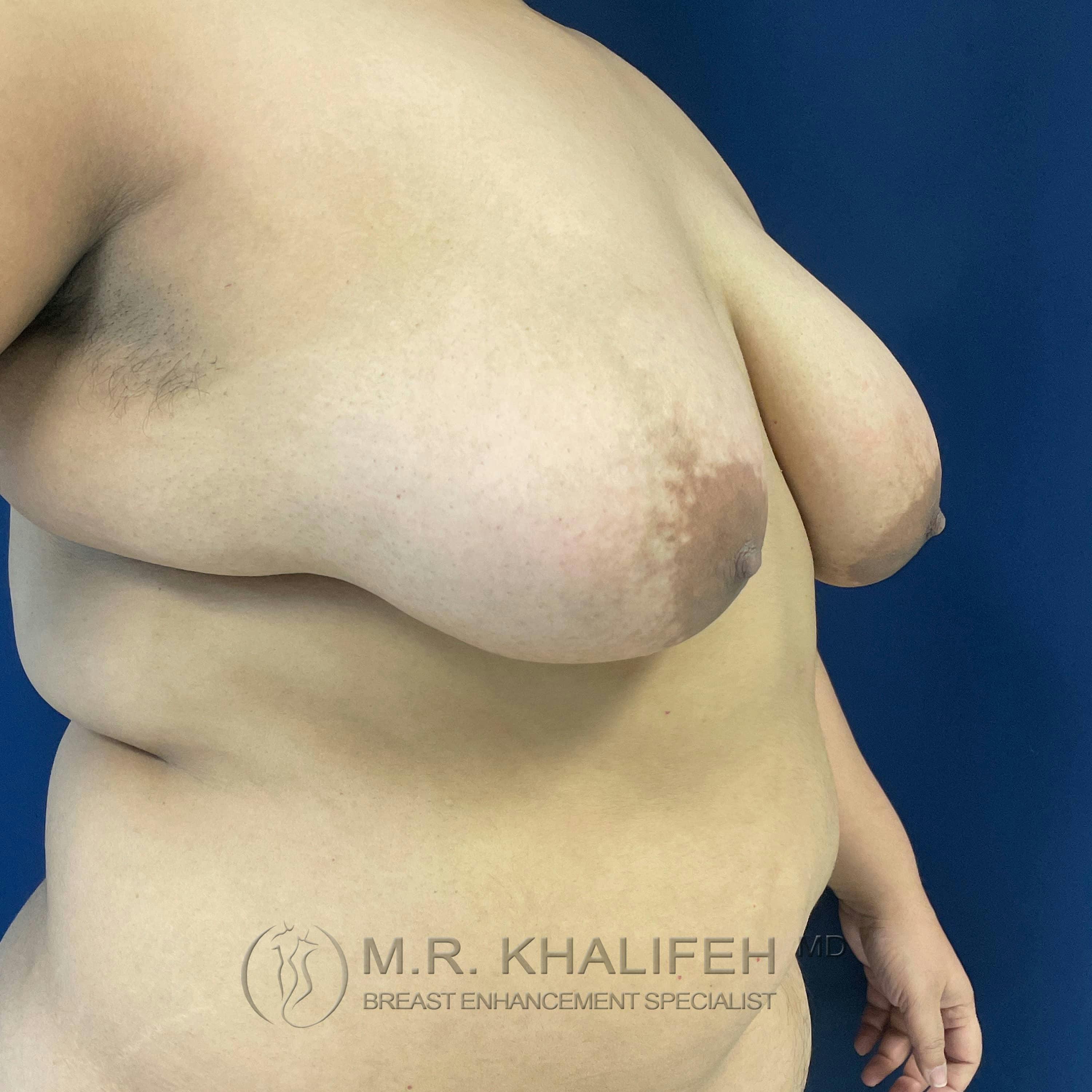 Breast Lift Gallery - Patient 122227116 - Image 7