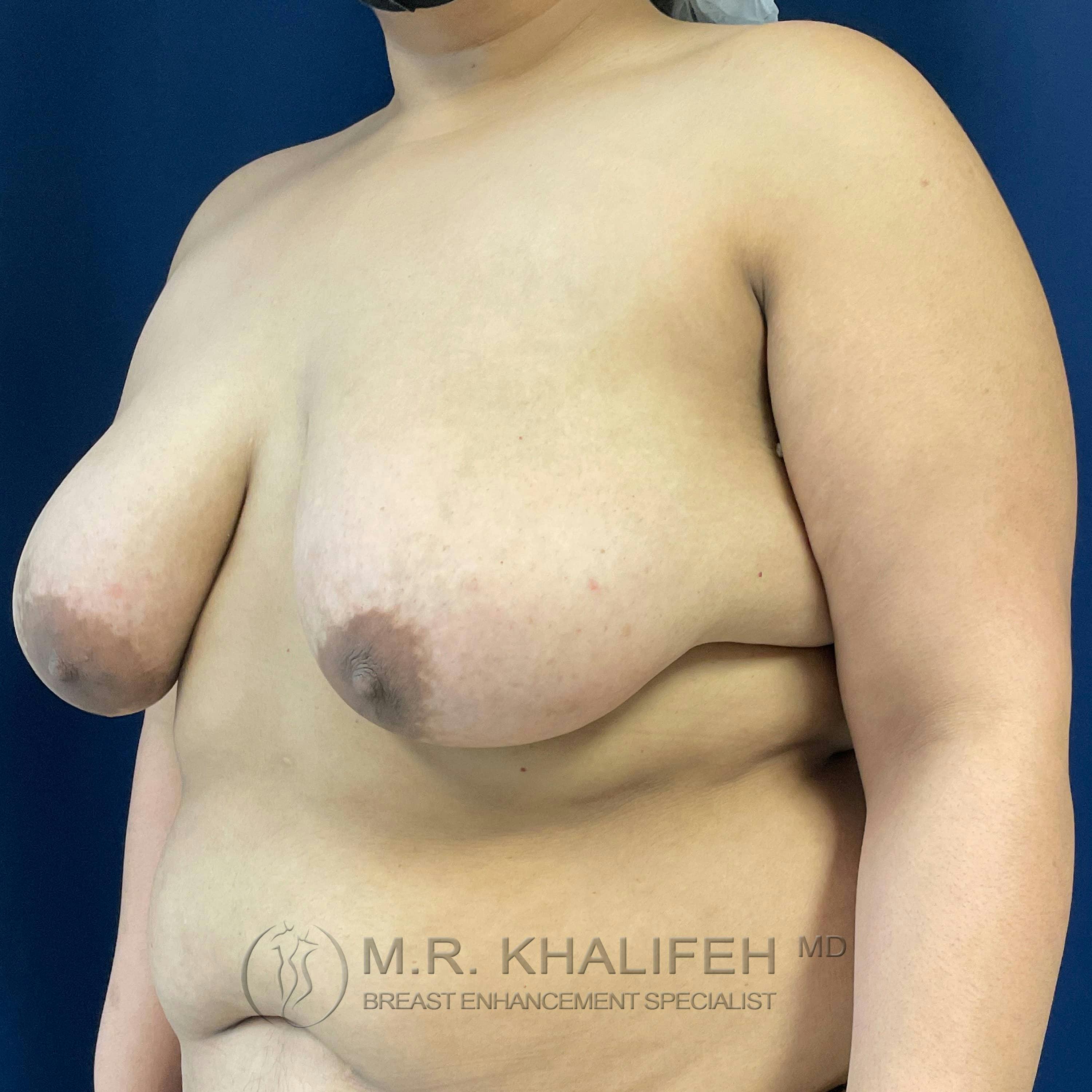 Breast Lift Gallery - Patient 122227116 - Image 3