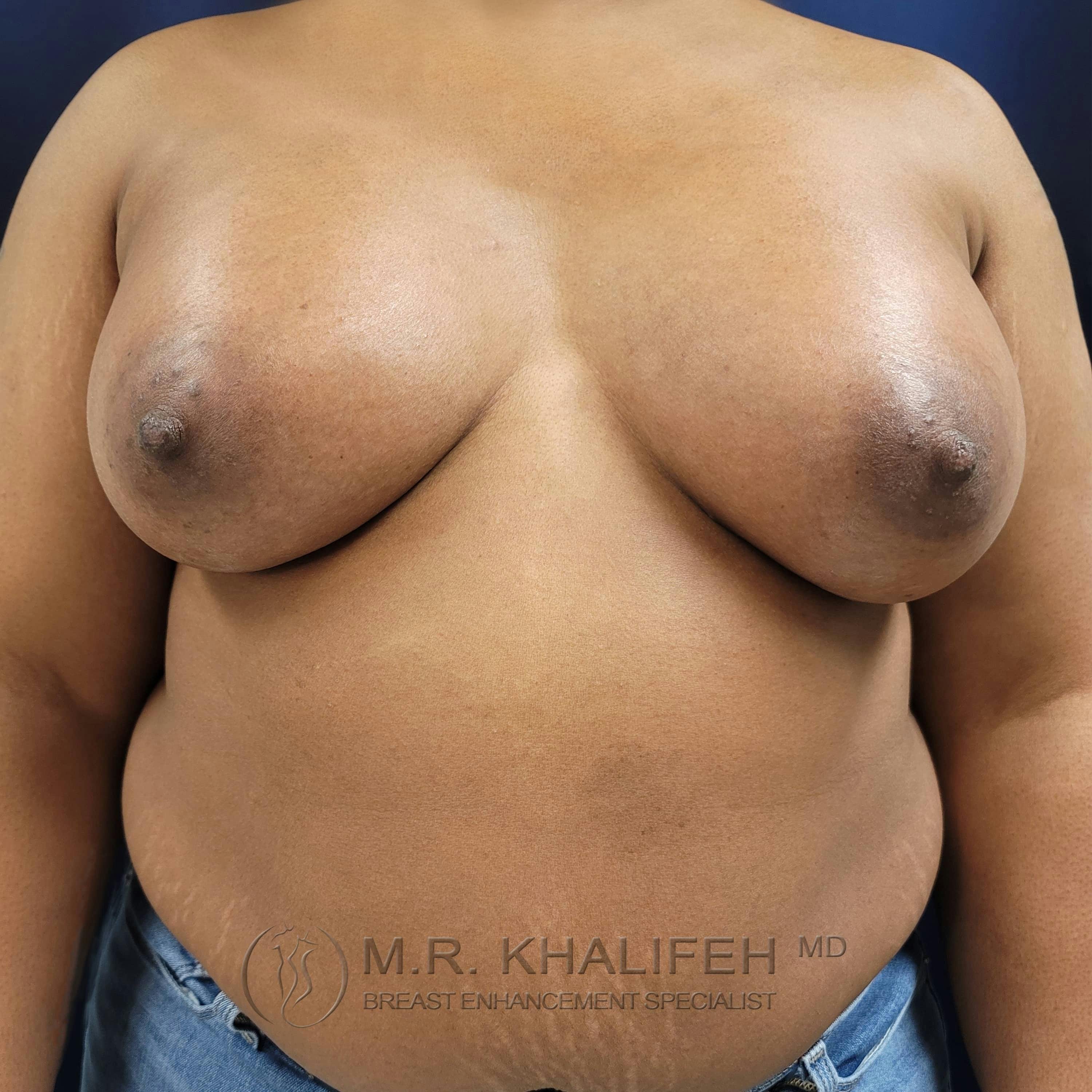 Breast Augmentation Gallery - Patient 122227133 - Image 2