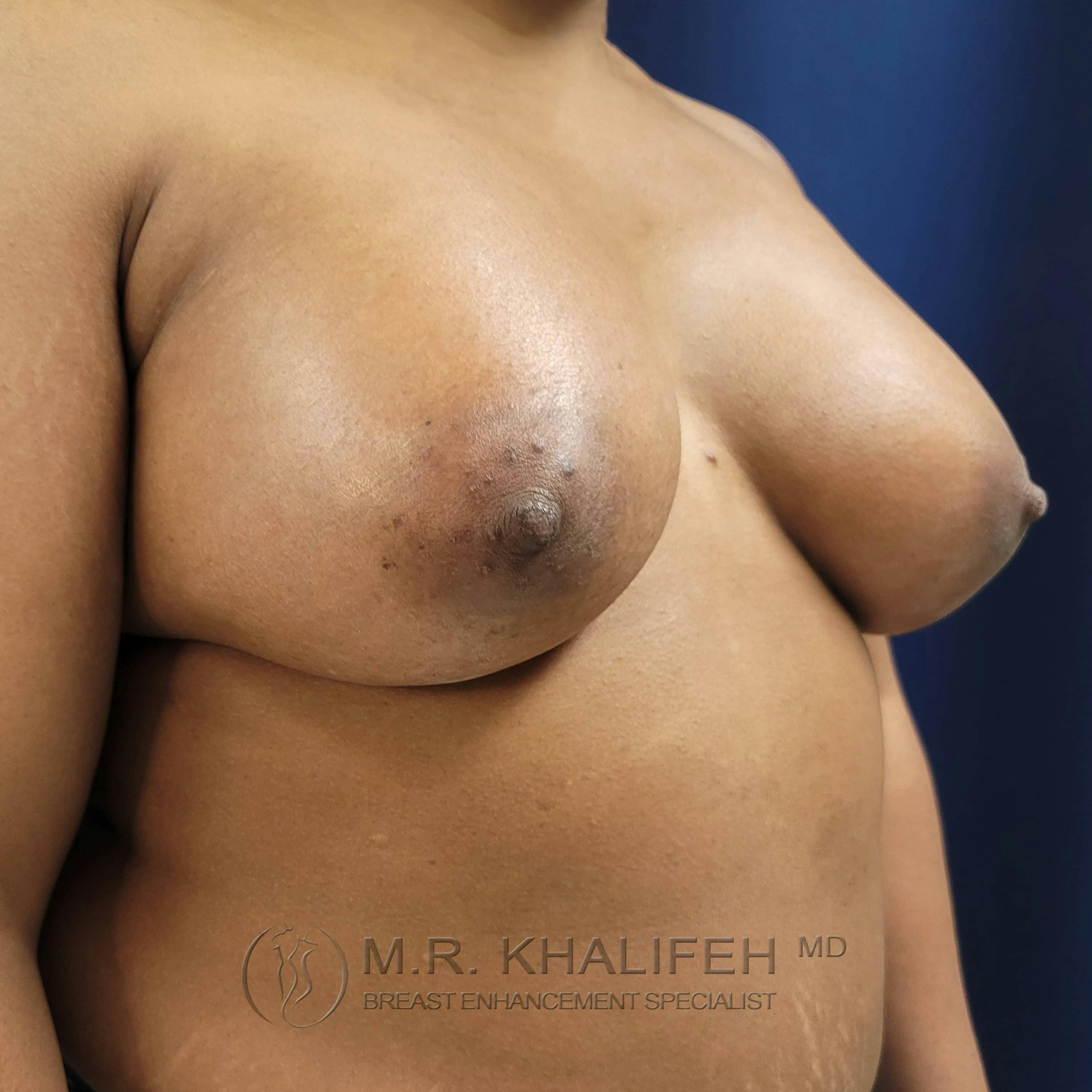 Breast Augmentation Gallery - Patient 122227133 - Image 8