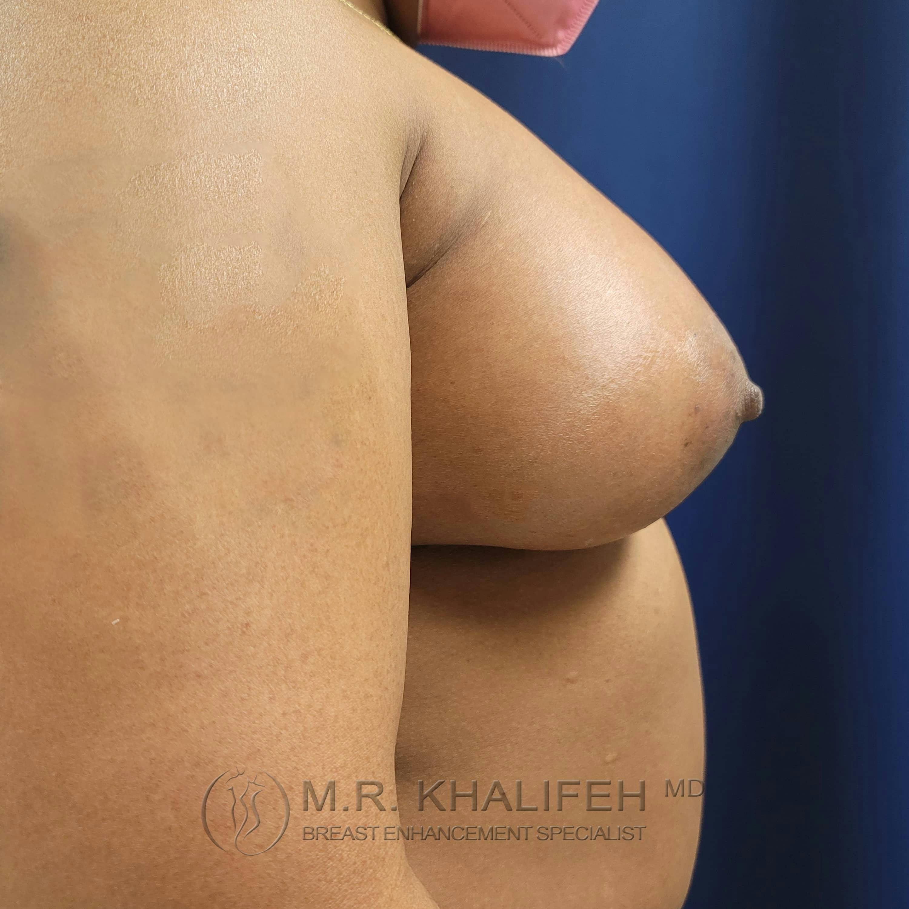 Breast Augmentation Gallery - Patient 122227133 - Image 10