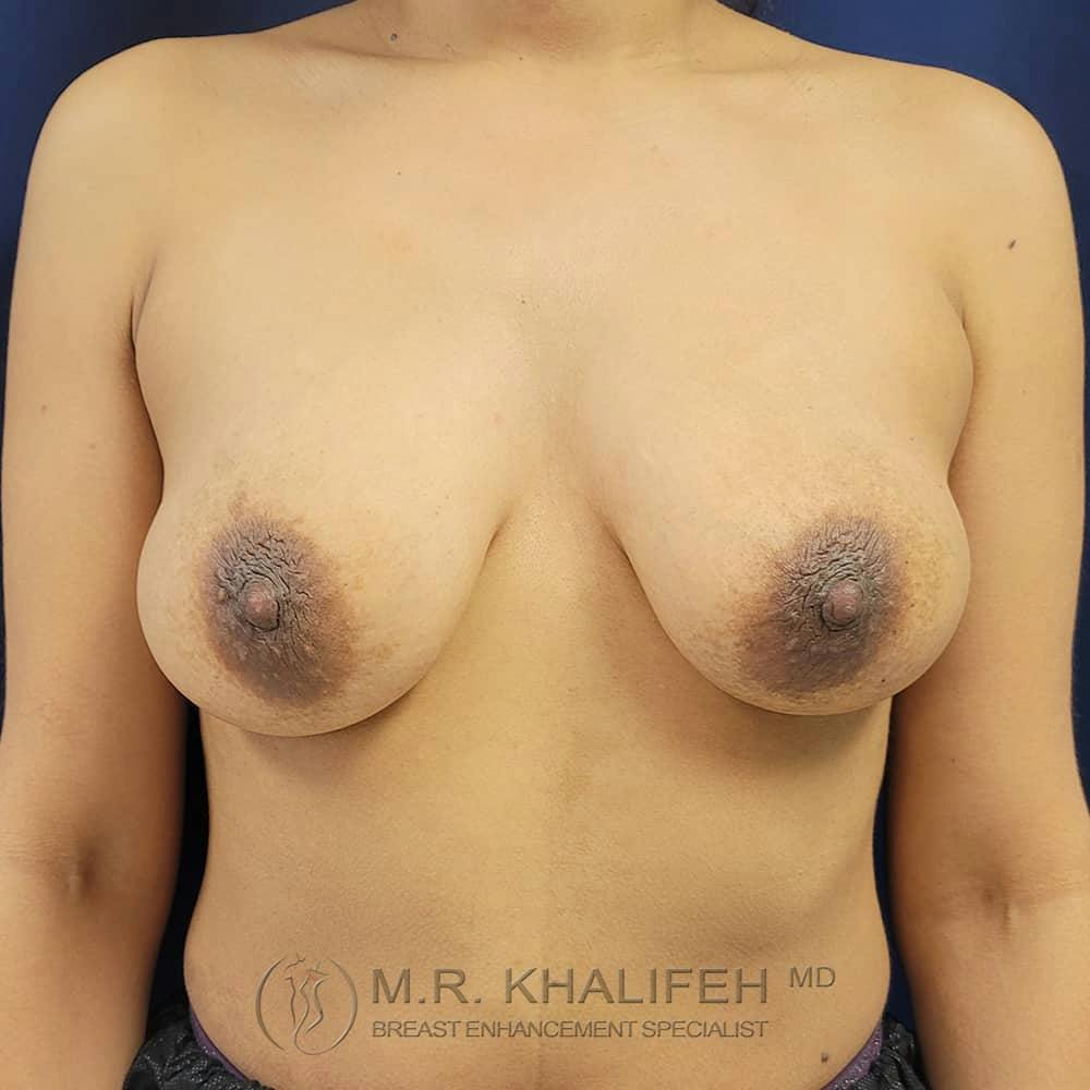 Breast Lift Gallery - Patient 122227180 - Image 1