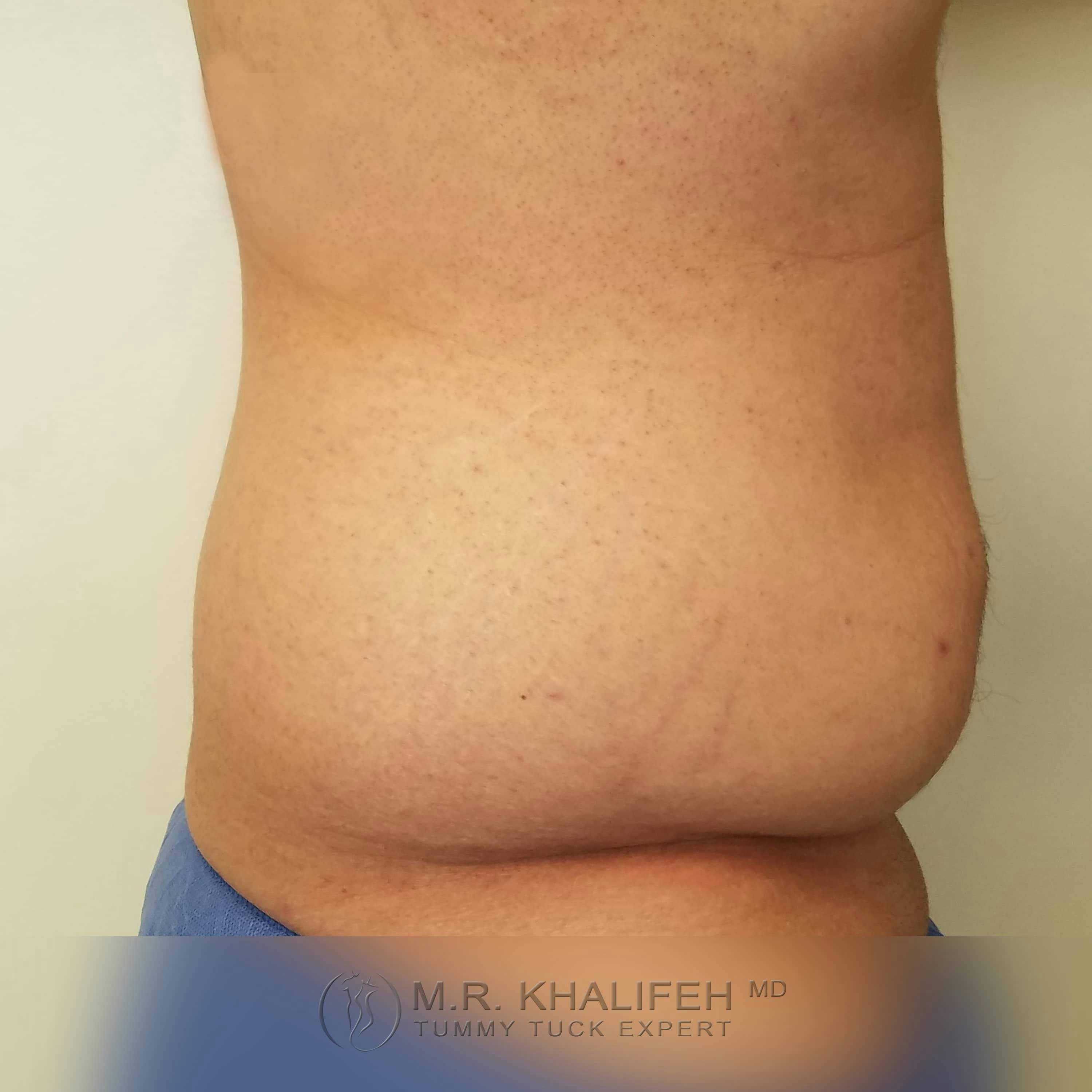 Male Tummy Tuck Gallery - Patient 122284648 - Image 5