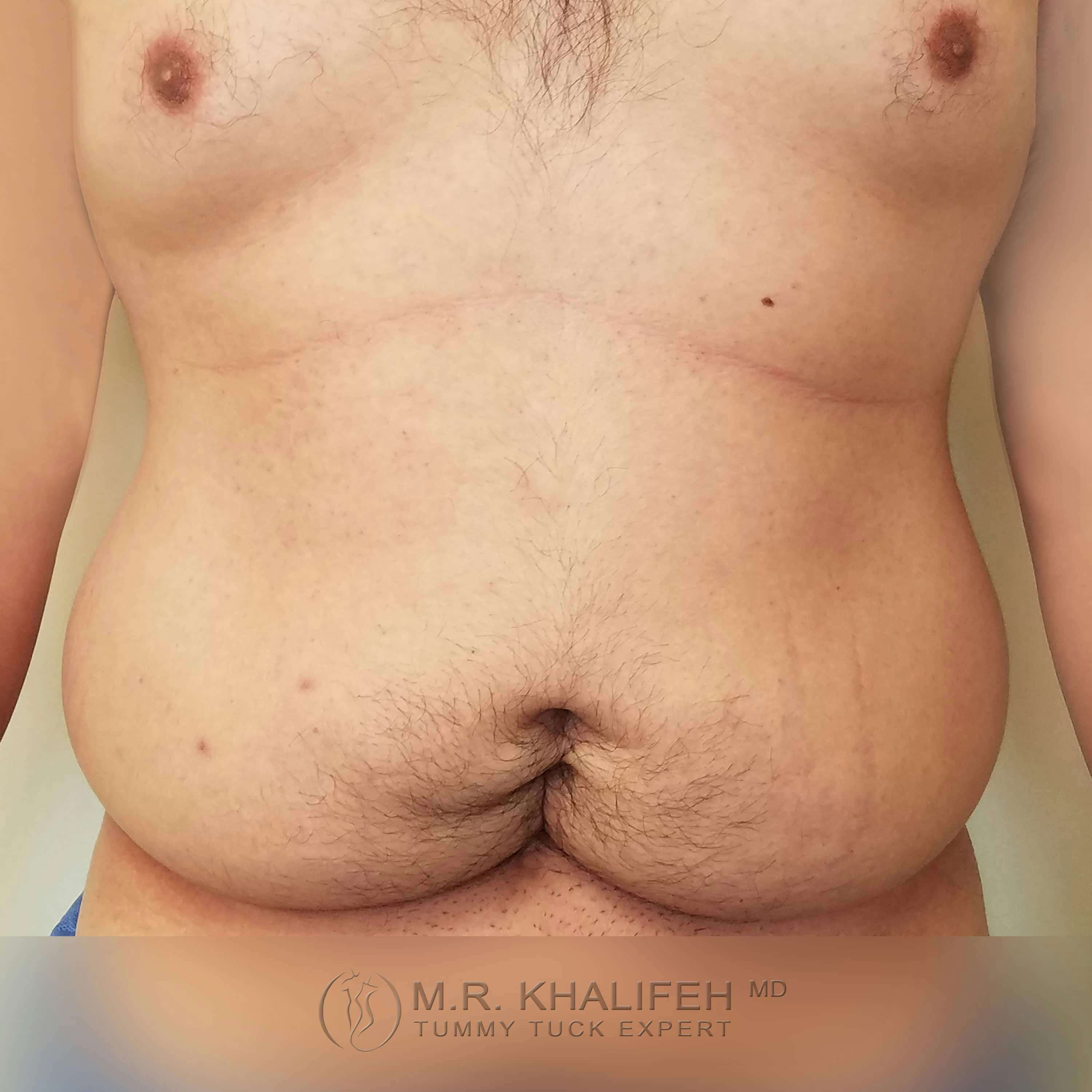 Male Tummy Tuck Gallery - Patient 122284648 - Image 1