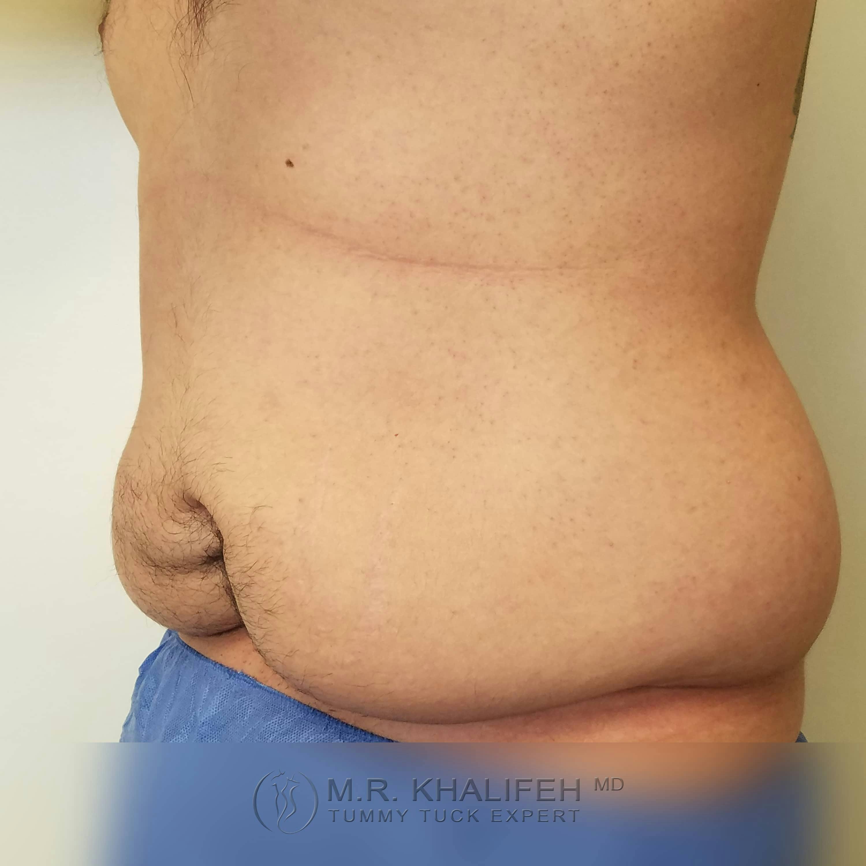 Male Tummy Tuck Gallery - Patient 122284648 - Image 7