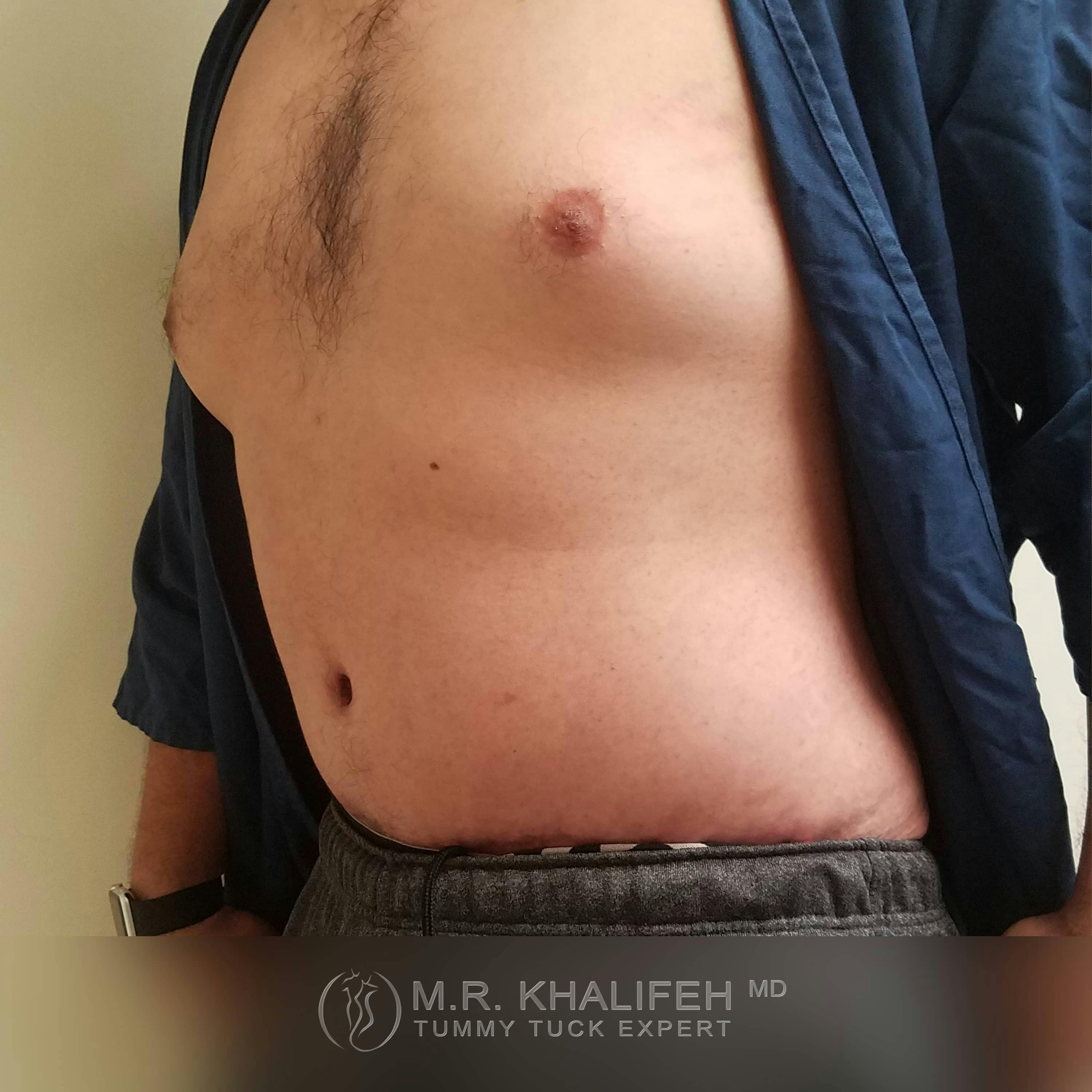 Male Tummy Tuck Gallery - Patient 122284648 - Image 8