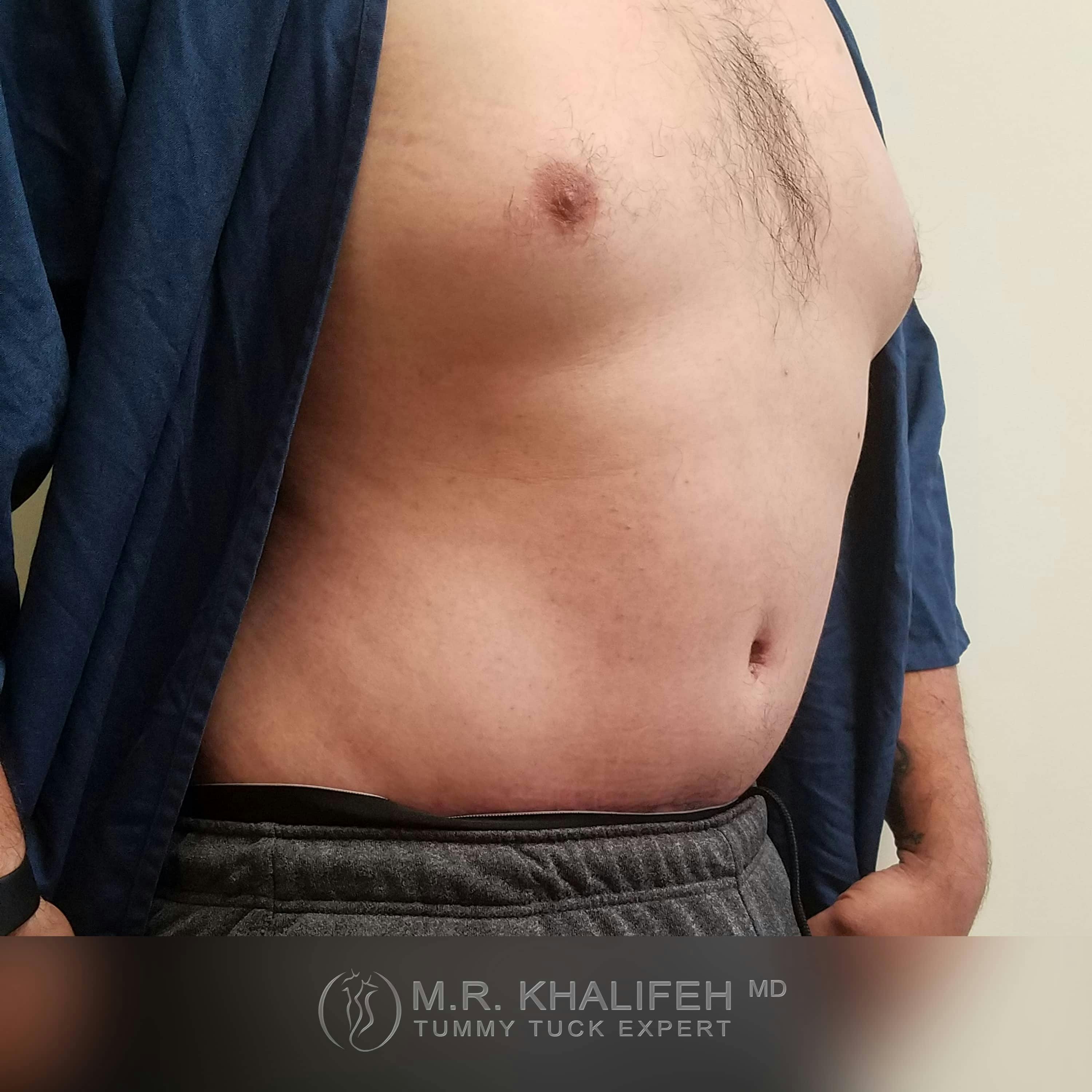 Male Tummy Tuck Gallery - Patient 122284648 - Image 4