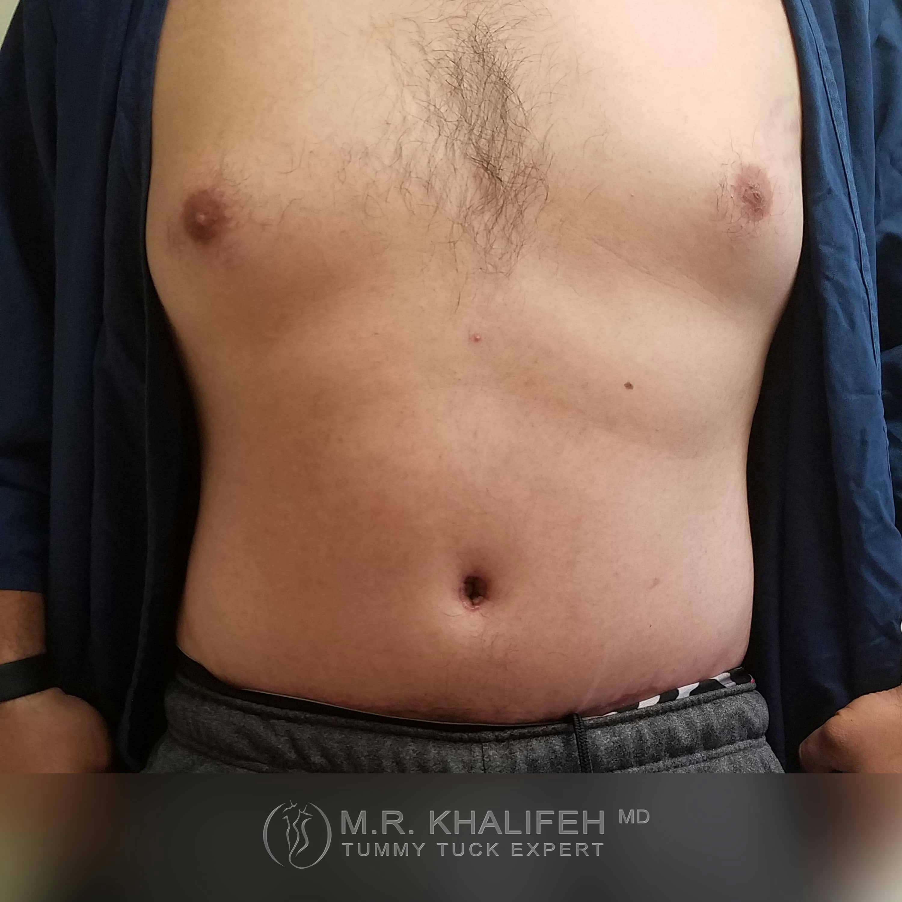 Male Tummy Tuck Gallery - Patient 122284648 - Image 2
