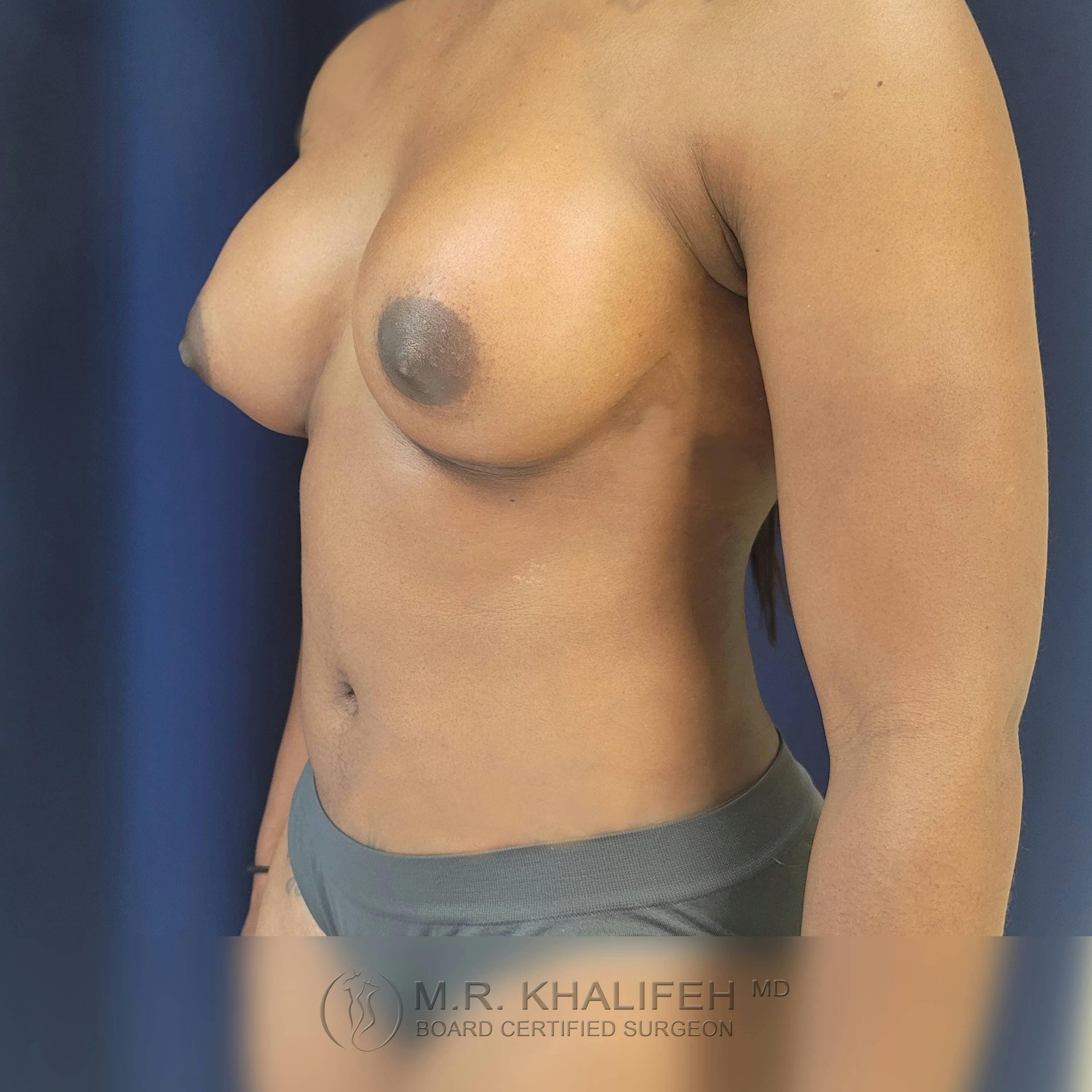 Breast Augmentation Gallery - Patient 122392749 - Image 4