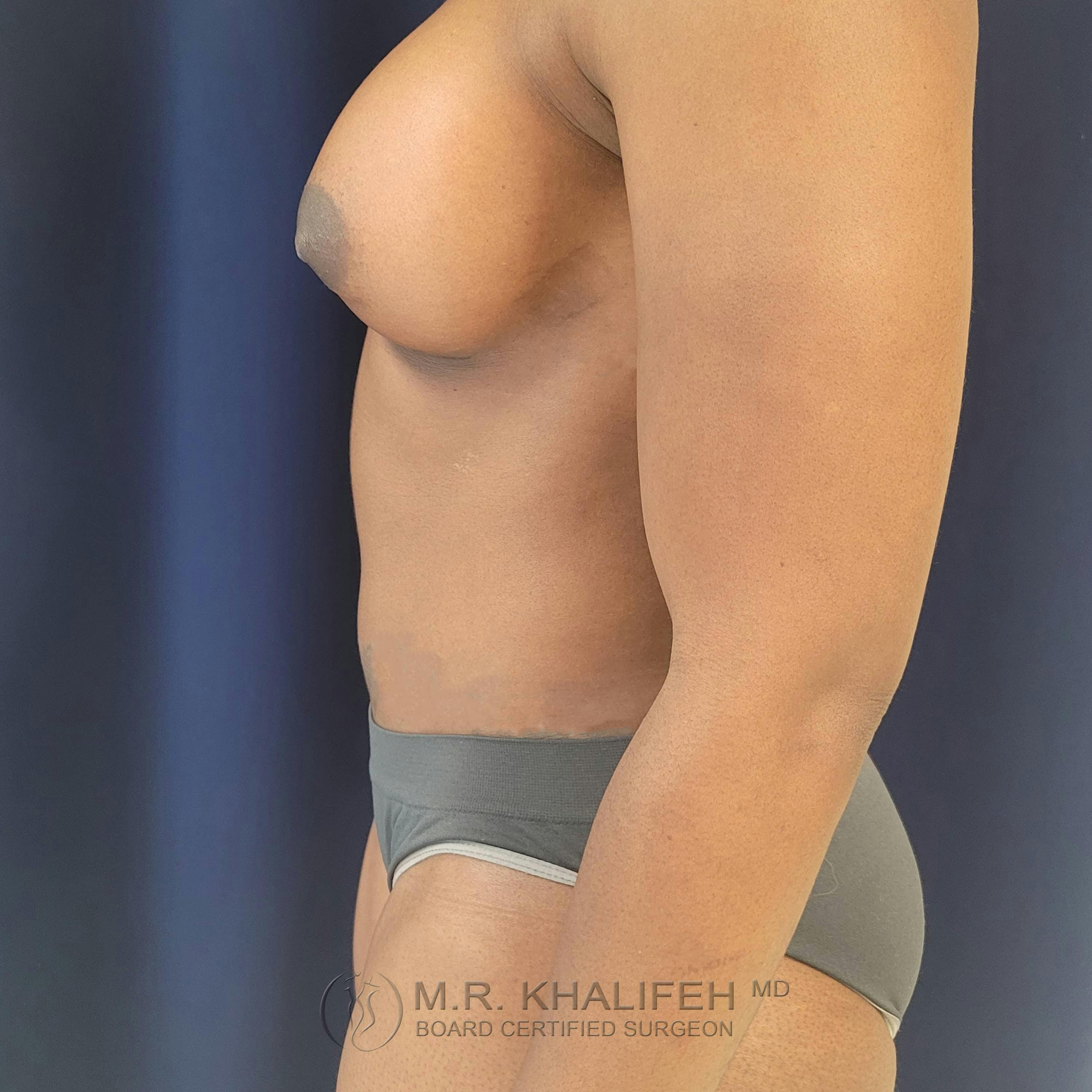 Breast Augmentation Gallery - Patient 122392749 - Image 6