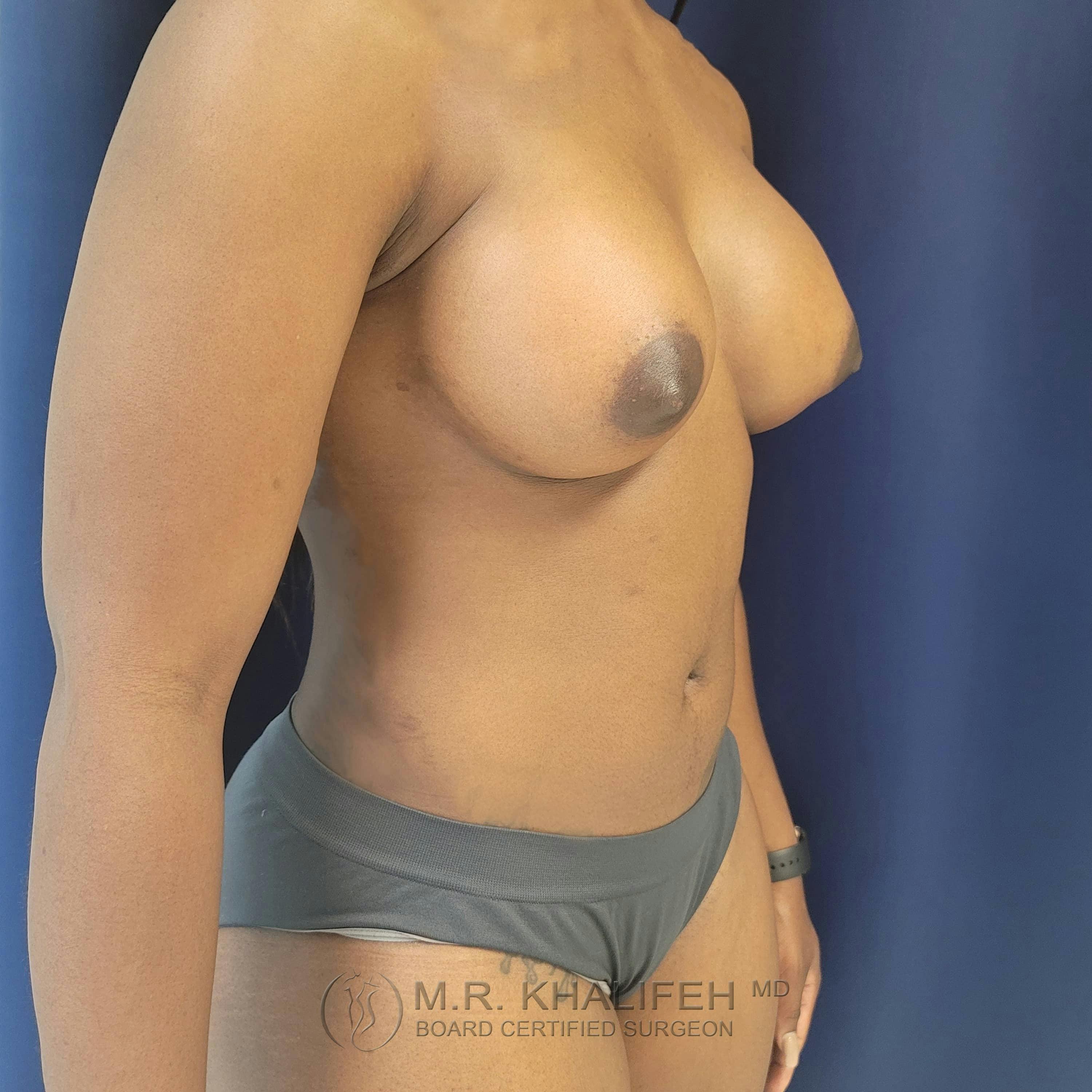 Breast Augmentation Gallery - Patient 122392749 - Image 8