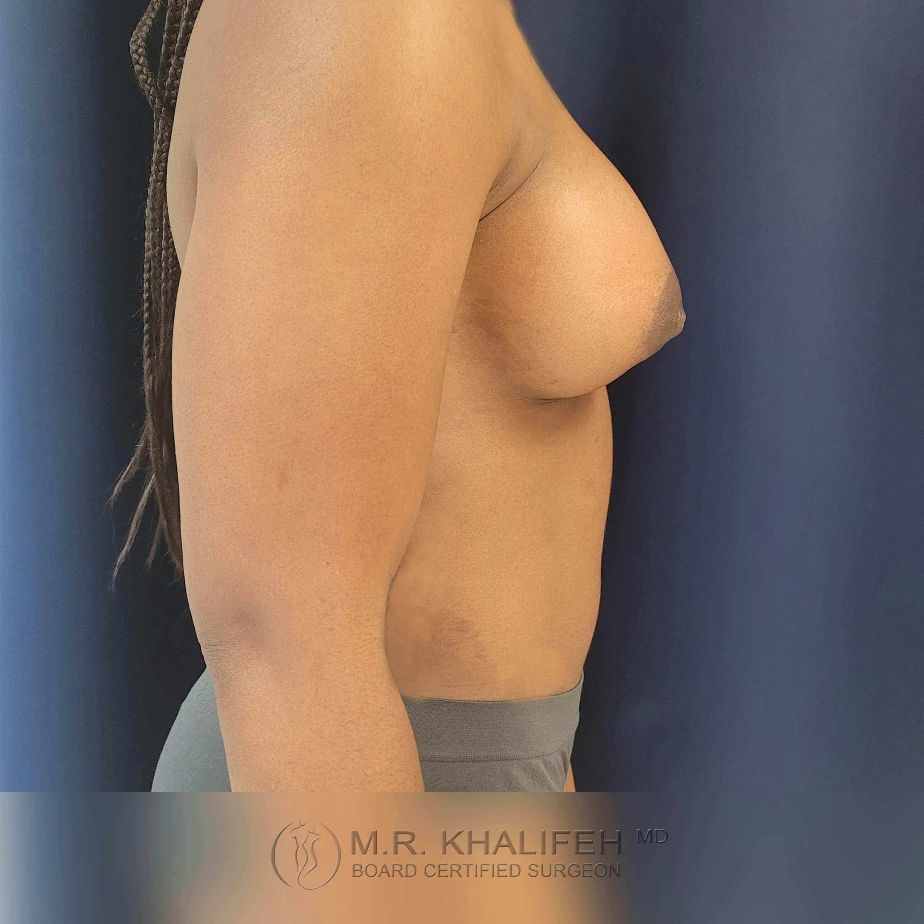 Breast Augmentation Gallery - Patient 122392749 - Image 10