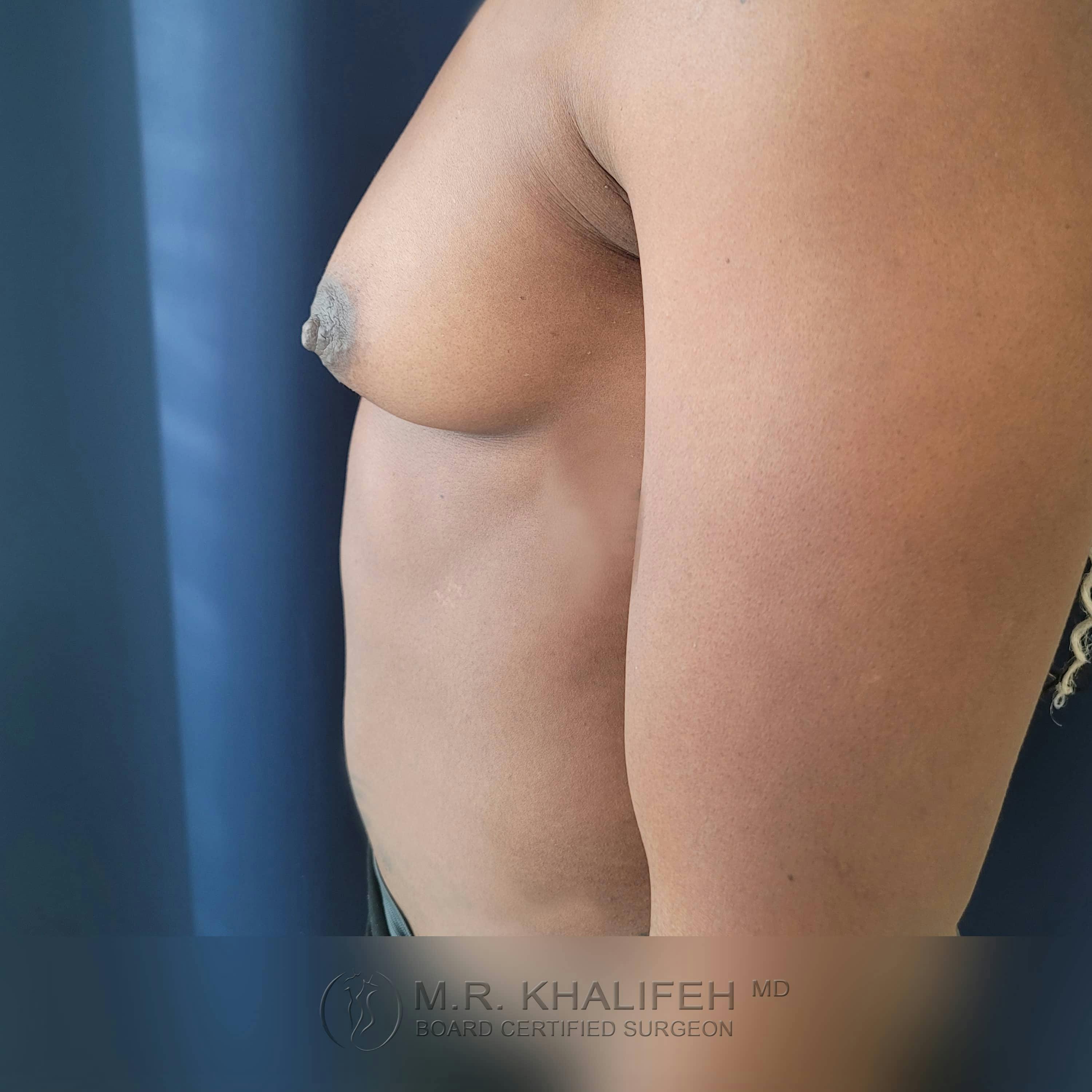 Breast Augmentation Gallery - Patient 122392749 - Image 5