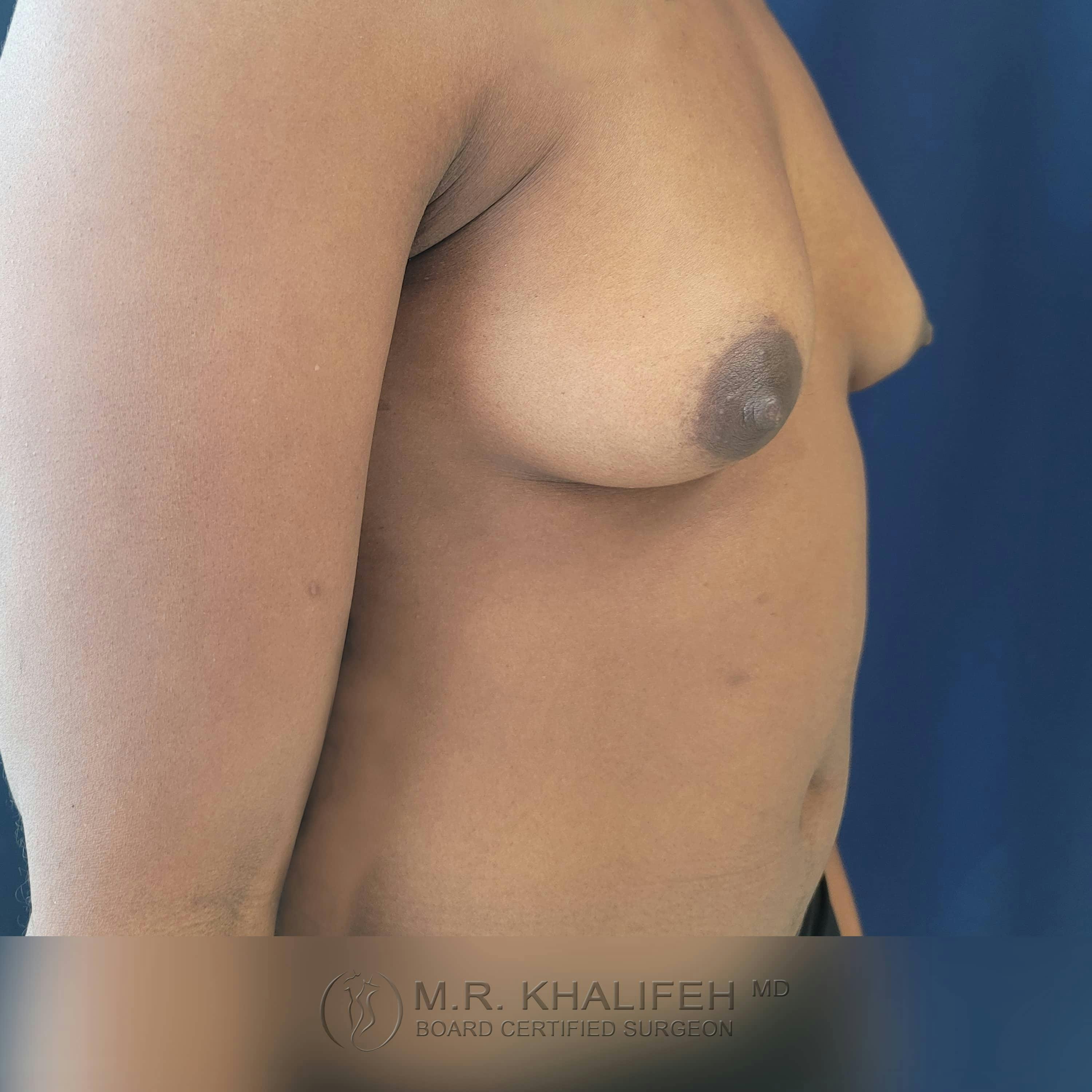 Breast Augmentation Gallery - Patient 122392749 - Image 7