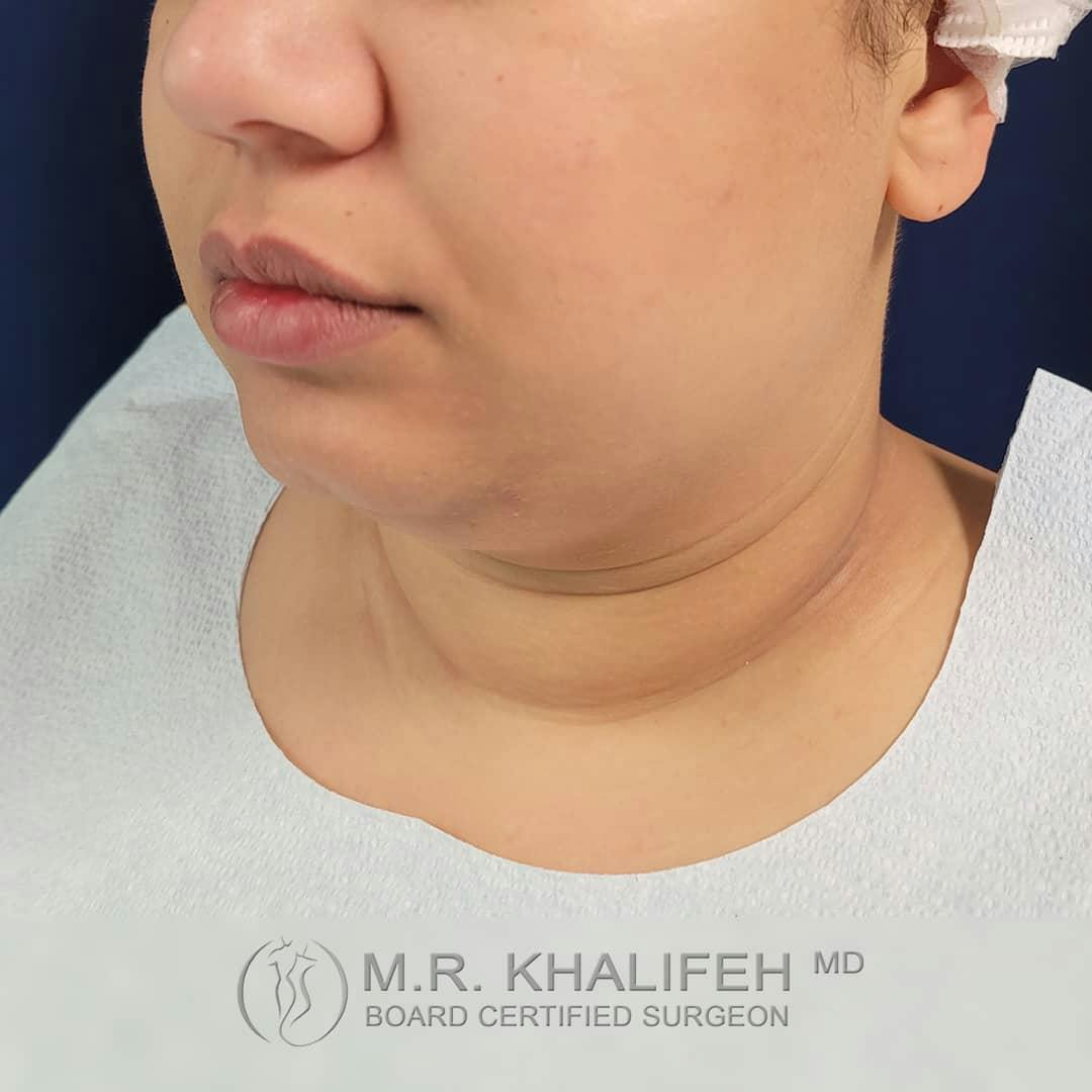 Chin and Neck Liposuction Gallery - Patient 122392776 - Image 7