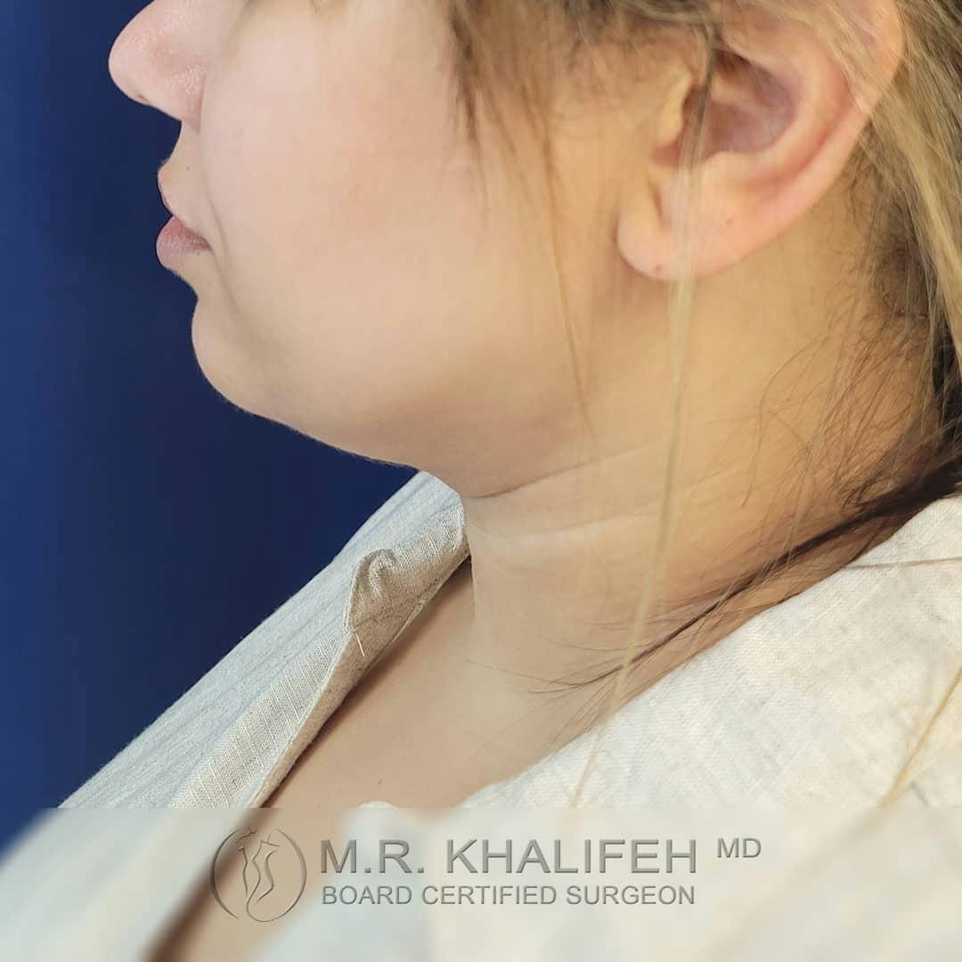 Chin and Neck Liposuction Gallery - Patient 122392776 - Image 10