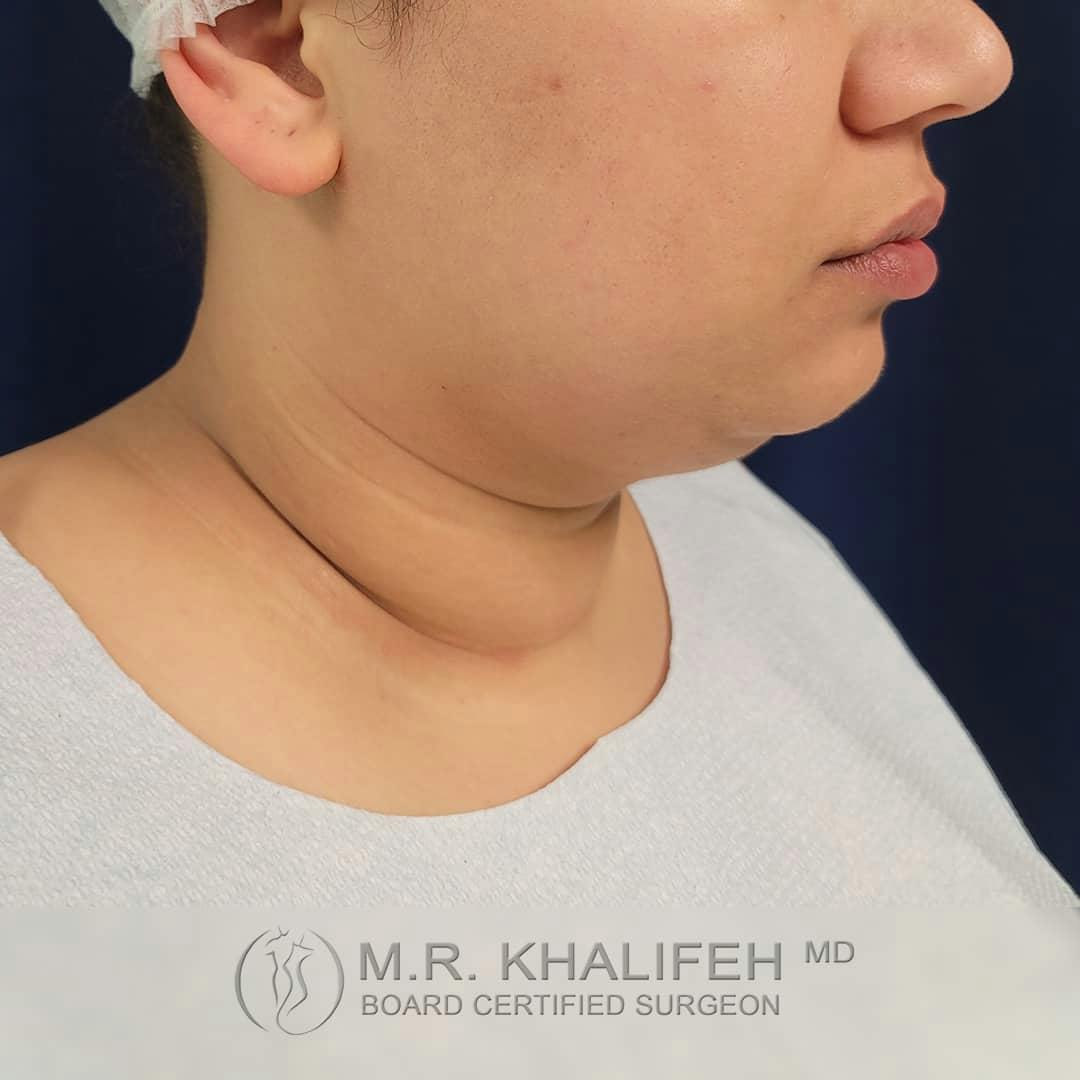 Chin and Neck Liposuction Gallery - Patient 122392776 - Image 3