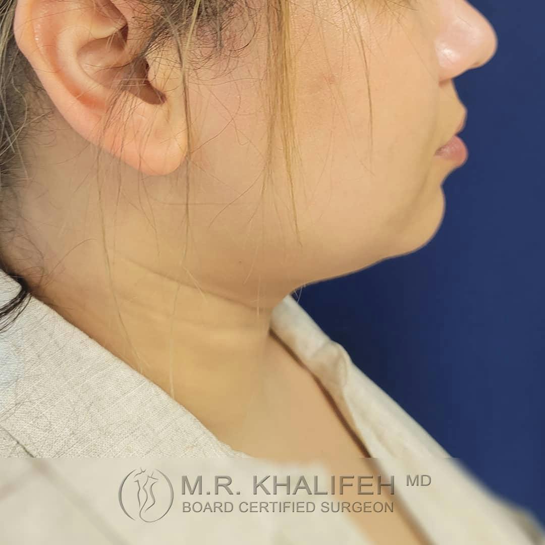 Chin and Neck Liposuction Gallery - Patient 122392776 - Image 2