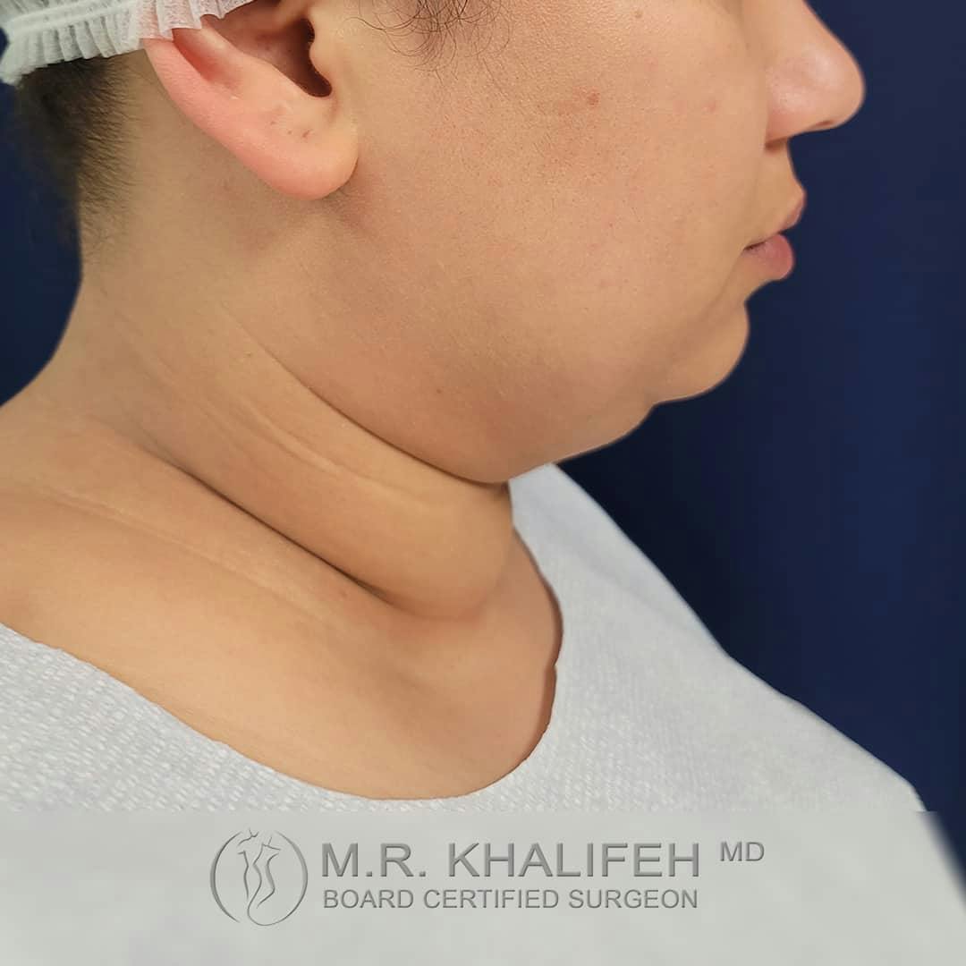 Chin and Neck Liposuction Gallery - Patient 122392776 - Image 1