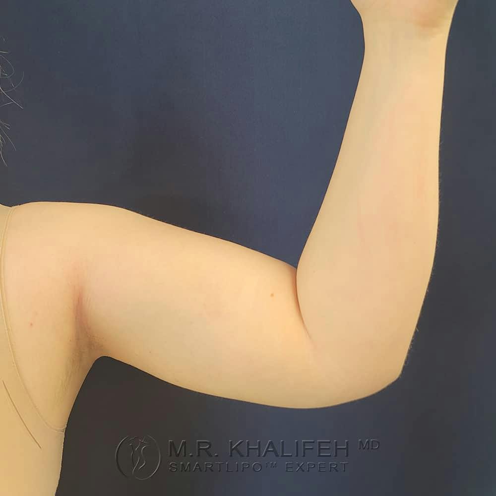 Arm Liposuction Gallery - Patient 122404227 - Image 2