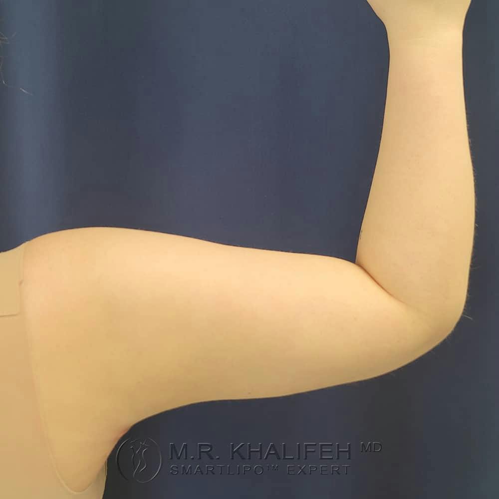 Arm Liposuction Gallery - Patient 122404227 - Image 4