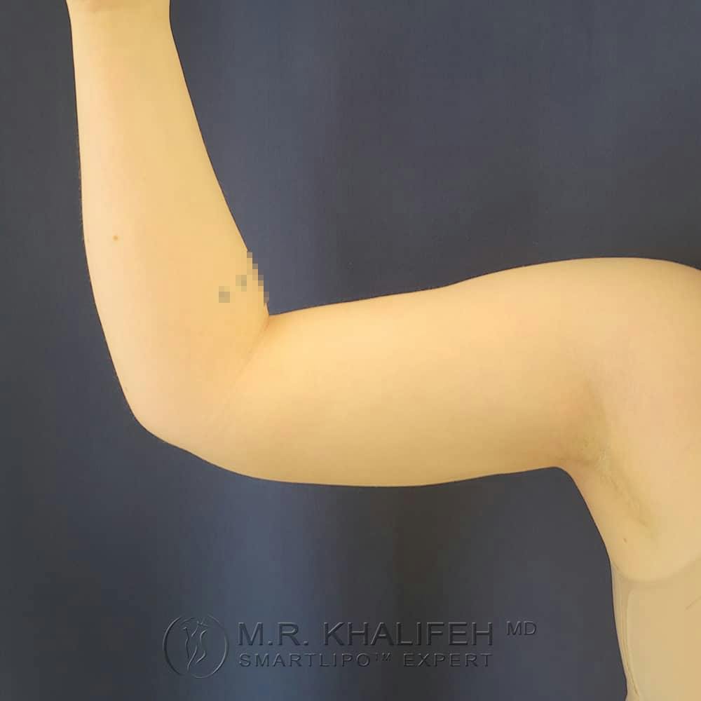 Arm Liposuction Gallery - Patient 122404227 - Image 6