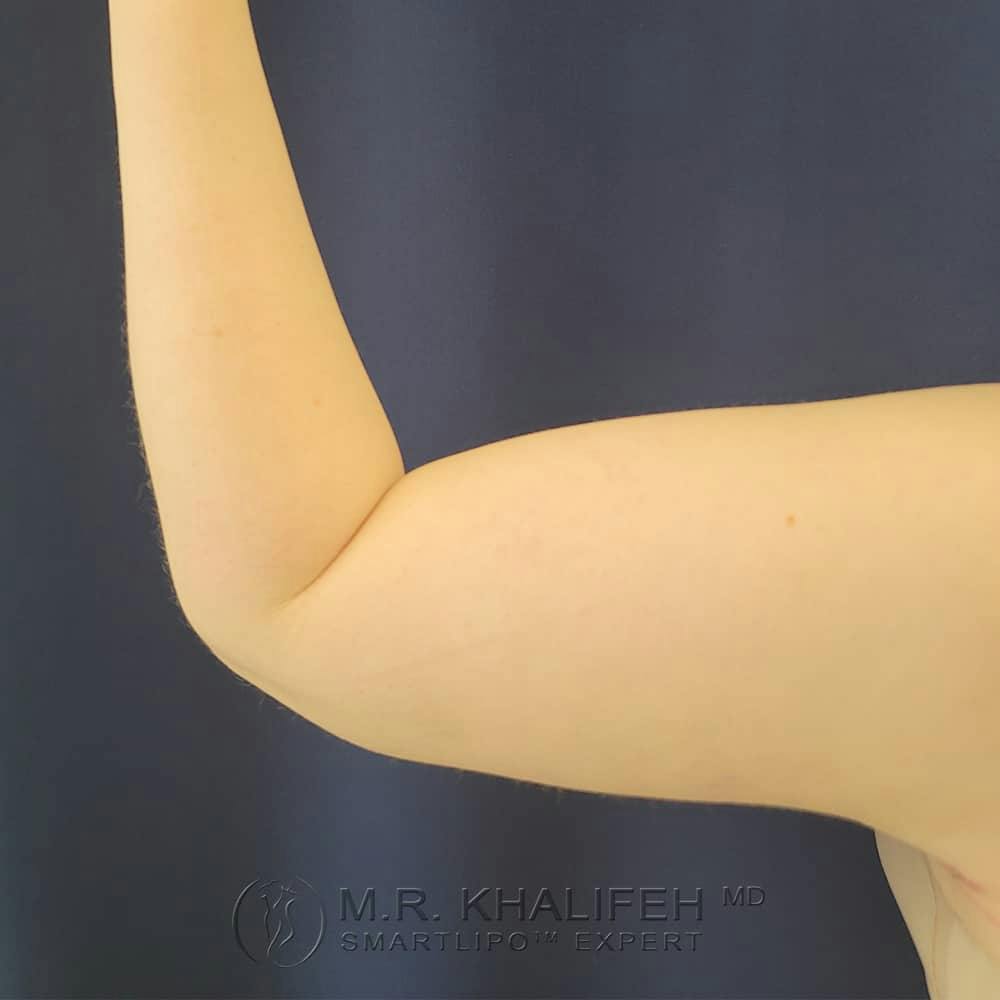 Arm Liposuction Gallery - Patient 122404227 - Image 8