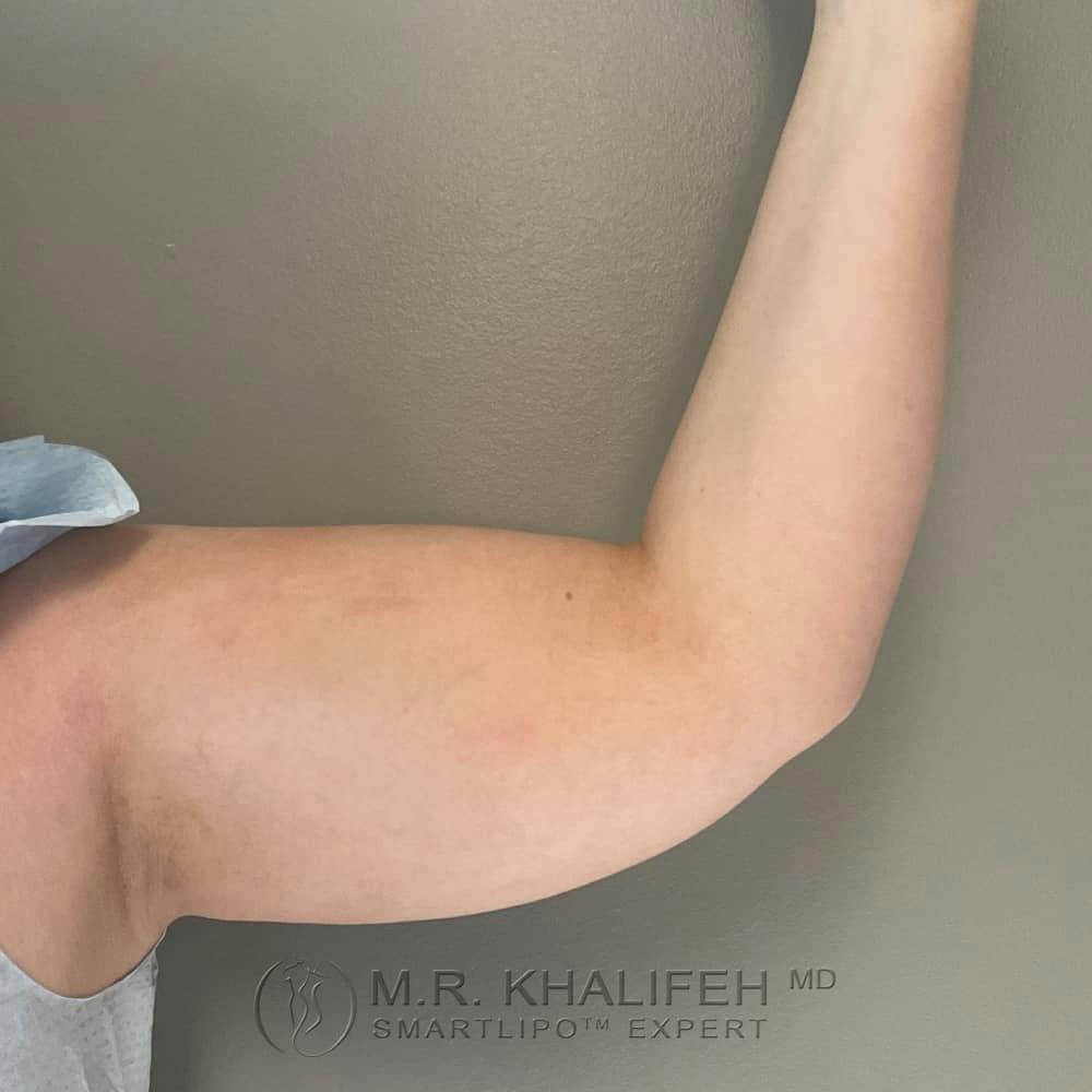 Arm Liposuction Gallery - Patient 122404227 - Image 1