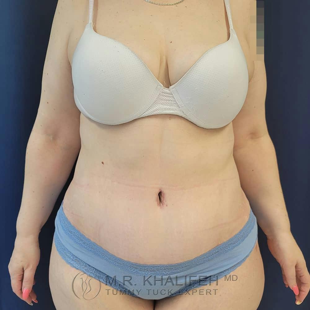 Tummy Tuck Gallery - Patient 122404242 - Image 2