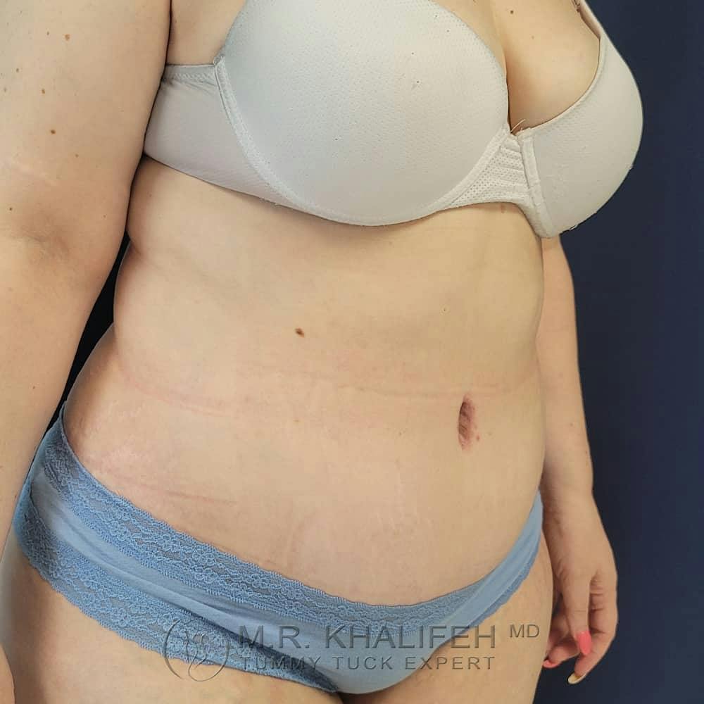 Tummy Tuck Gallery - Patient 122404242 - Image 4