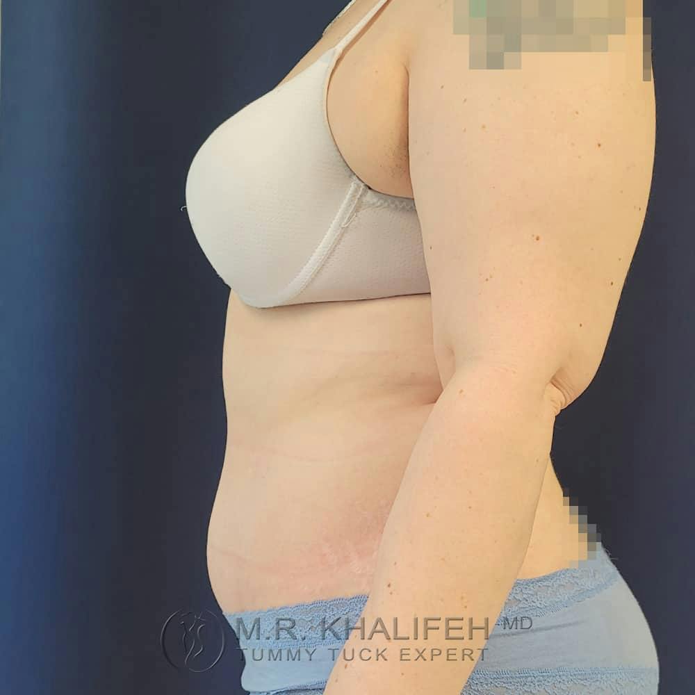 Tummy Tuck Gallery - Patient 122404242 - Image 10