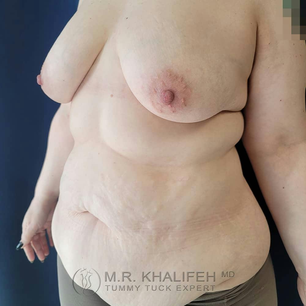 Tummy Tuck Gallery - Patient 122404242 - Image 7