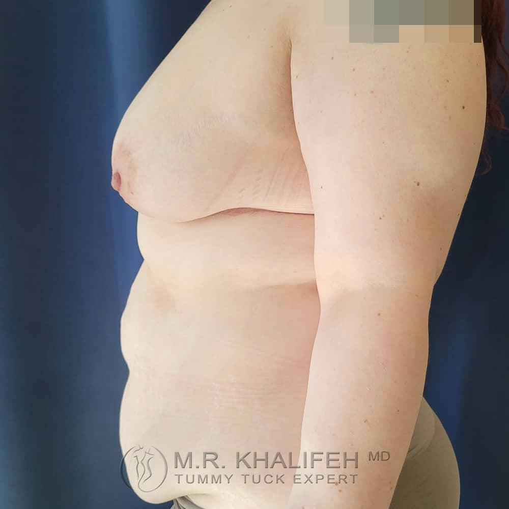 Tummy Tuck Gallery - Patient 122404242 - Image 9