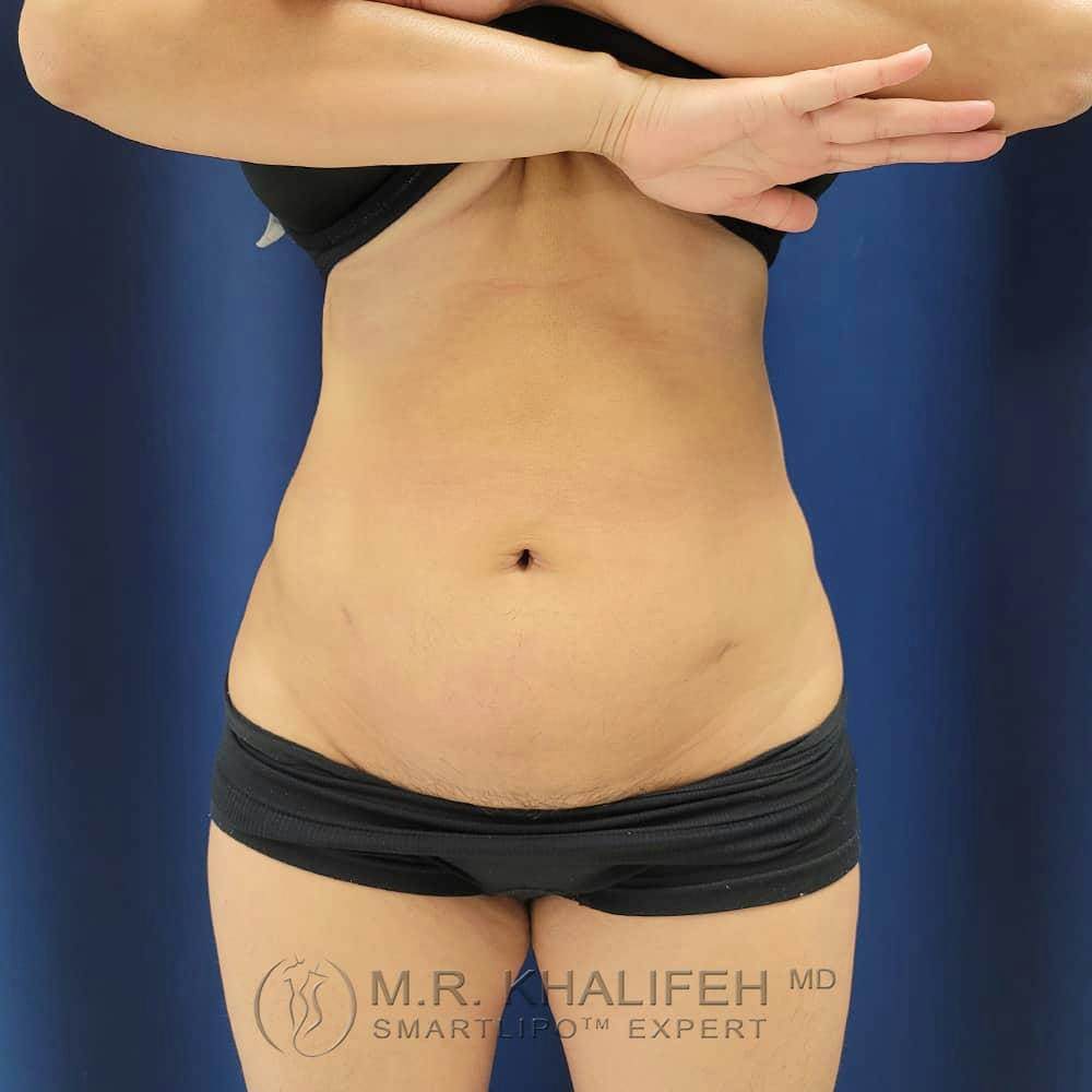 Abdominal Liposuction Gallery - Patient 122404271 - Image 2