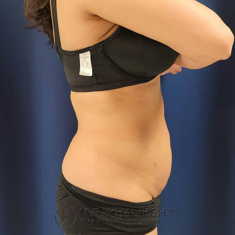 Abdominal Liposuction Gallery - Patient 122404271 - Image 4