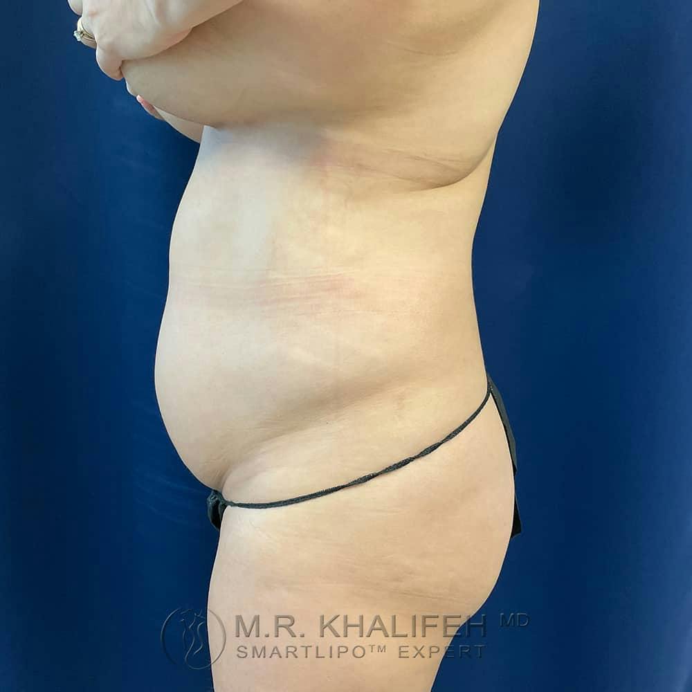 Abdominal Liposuction Gallery - Patient 122404271 - Image 7
