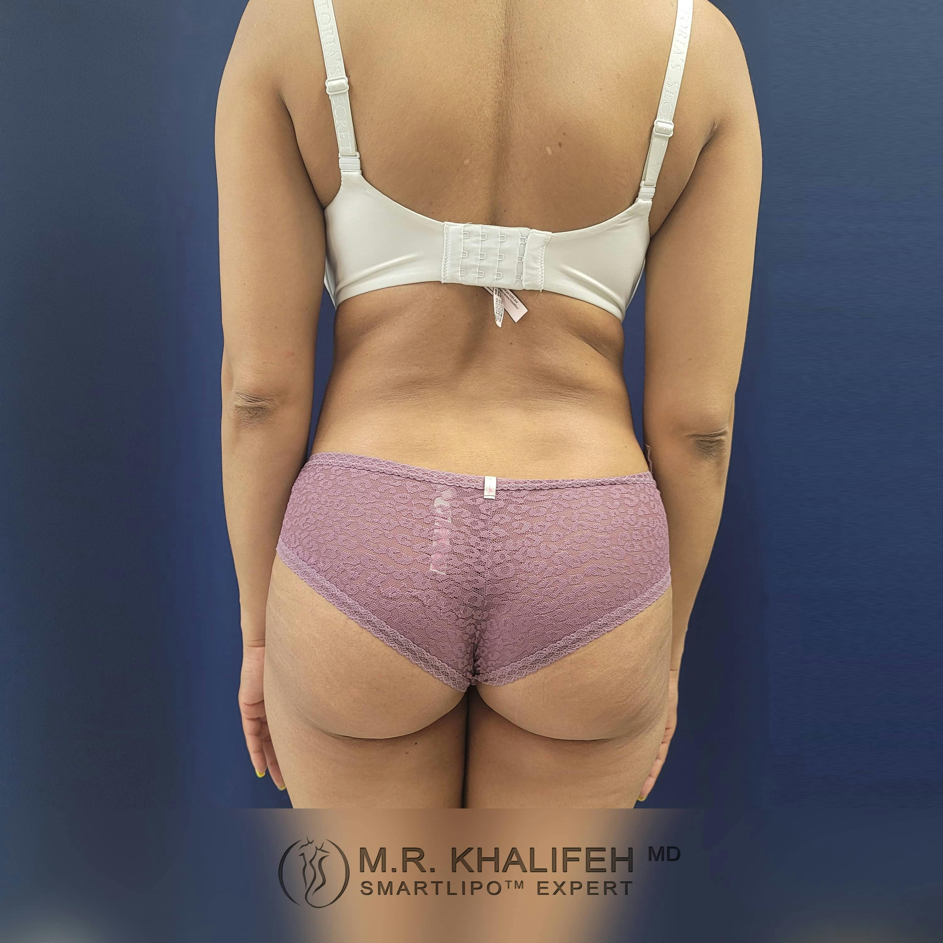 Abdominal Liposuction Gallery - Patient 122404295 - Image 6