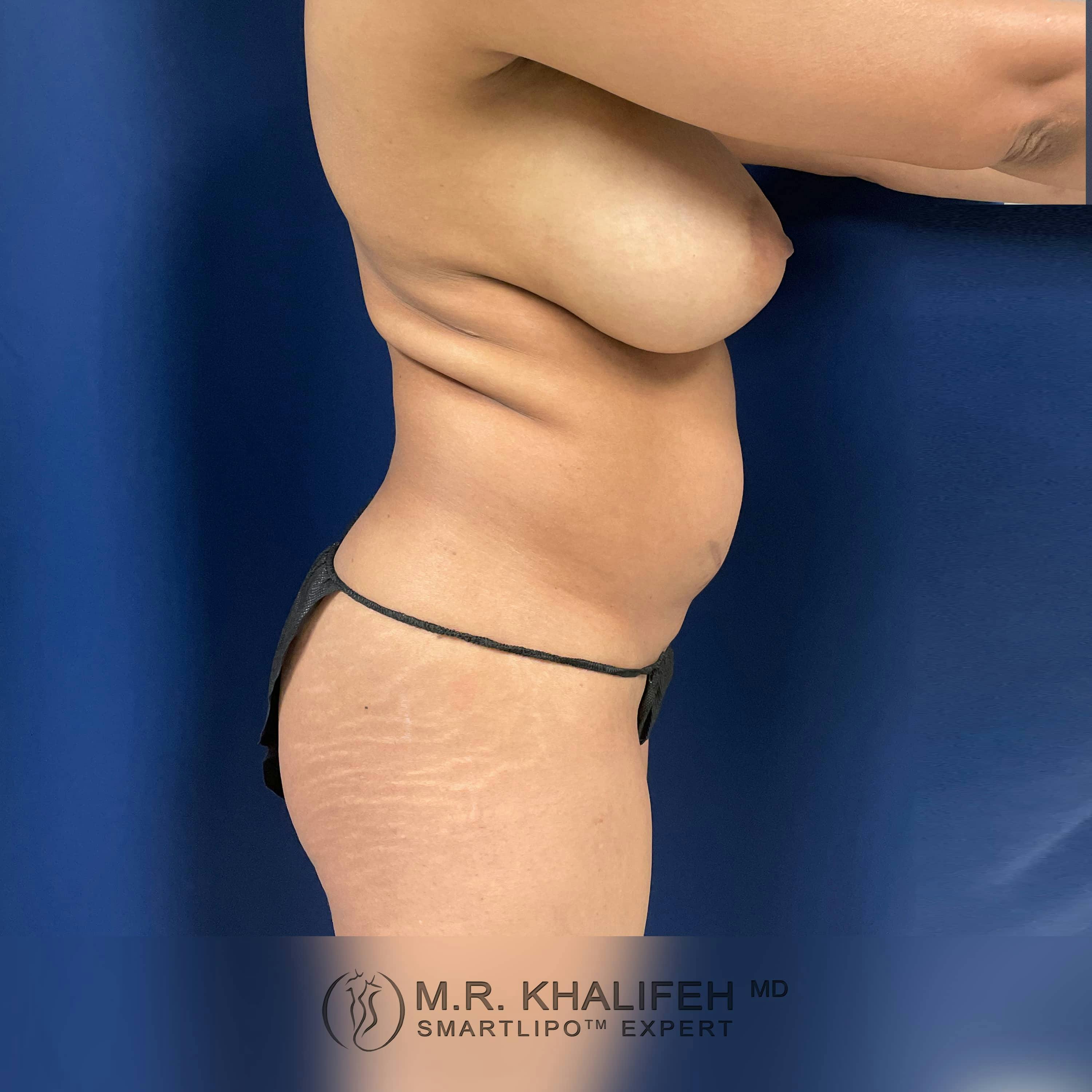 Abdominal Liposuction Gallery - Patient 122404295 - Image 1