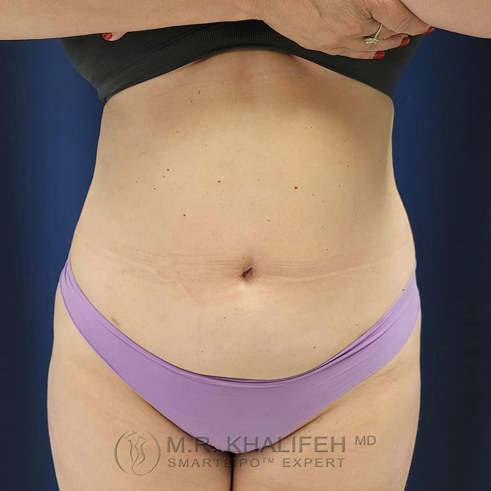 Abdominal Liposuction Gallery - Patient 122623079 - Image 2